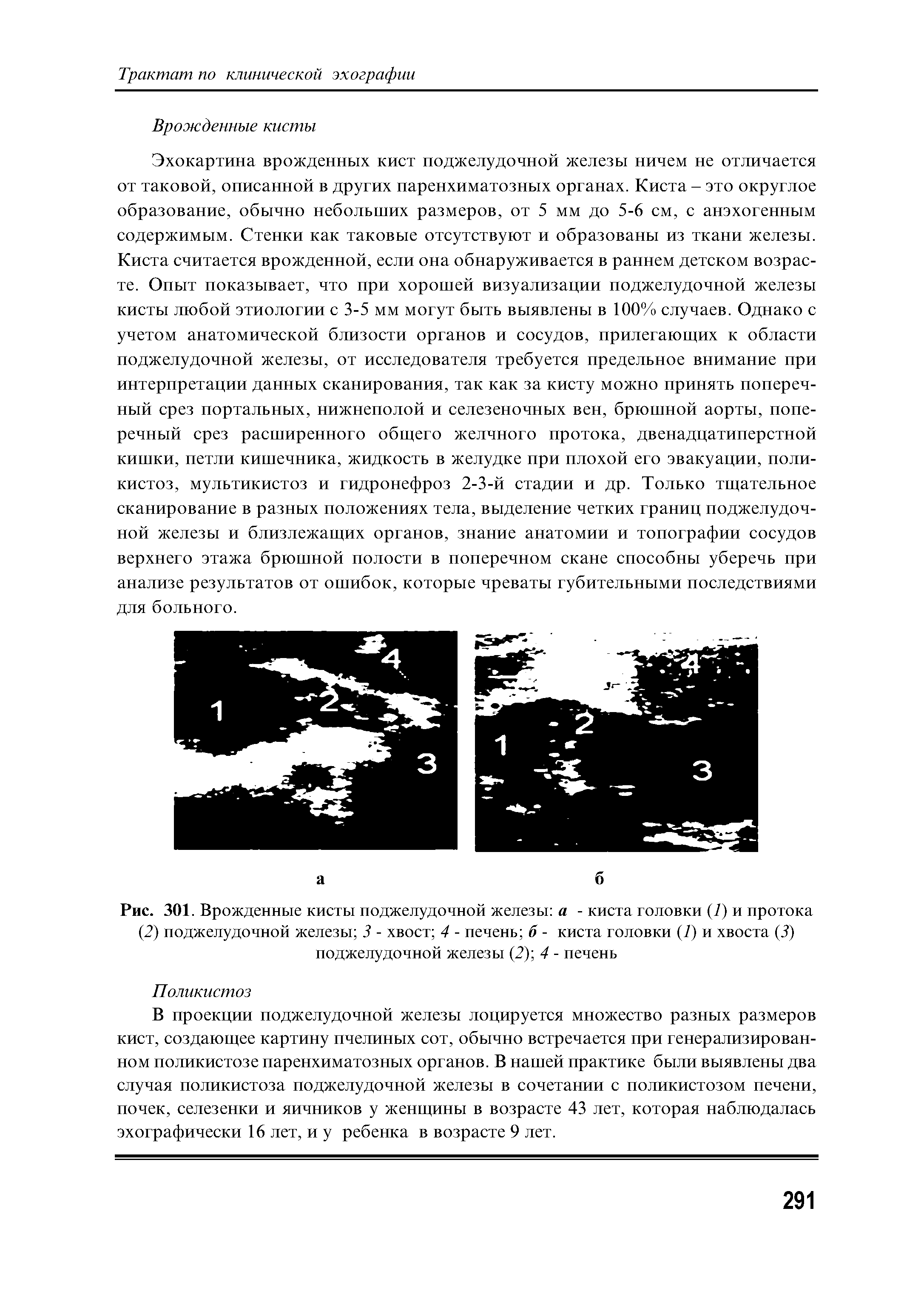 Рис. 301. Врожденные кисты поджелудочной железы а - киста головки (7) и протока (2) поджелудочной железы 3 - хвост 4 - печень б - киста головки (7) и хвоста (3) поджелудочной железы (2) 4 - печень...