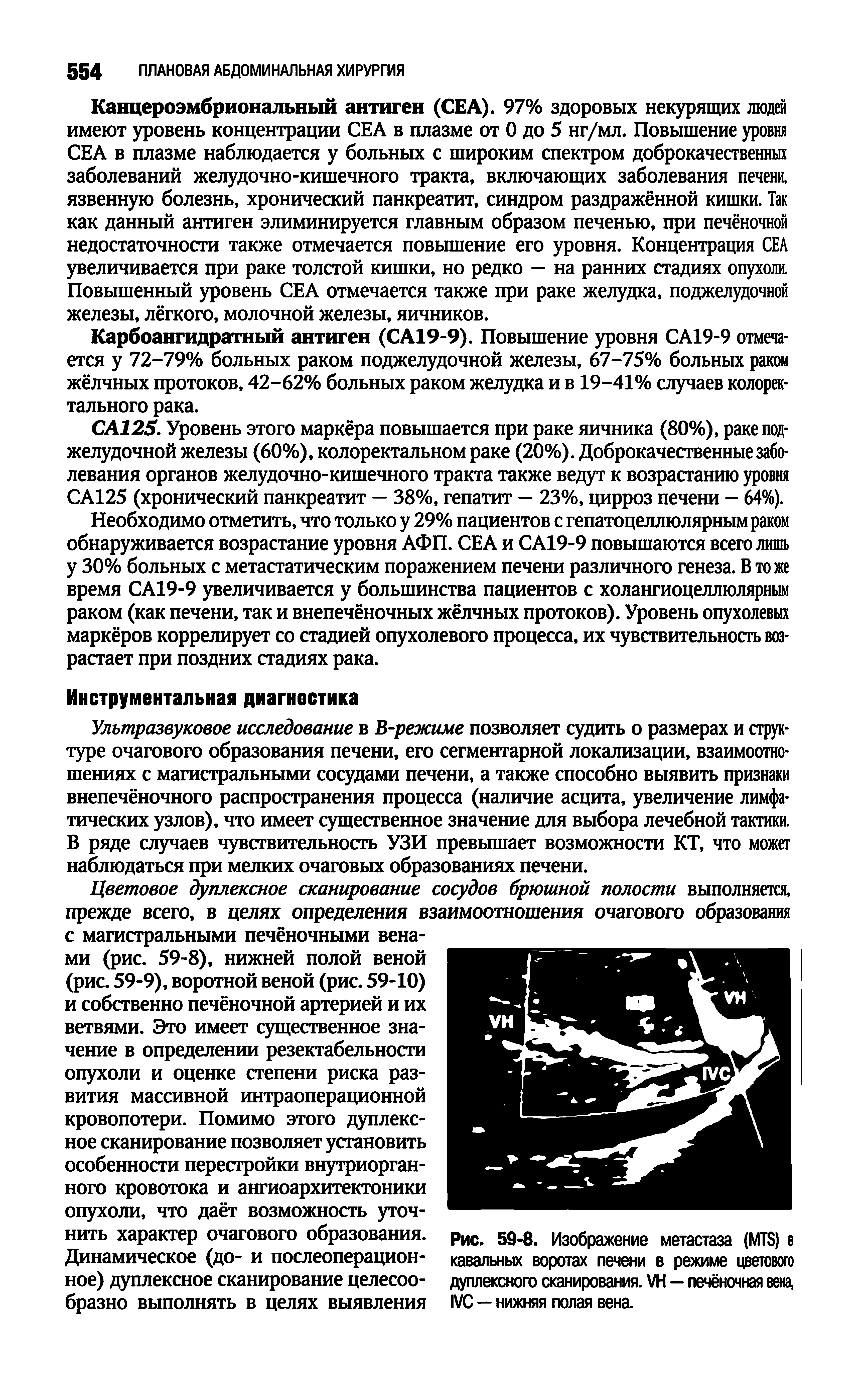 Рис. 59-8. Изображение метастаза (MTS) в кавальных воротах печени в режиме цветового дуплексного сканирования. VH — печёночная вена, IVC — нижняя полая вена.