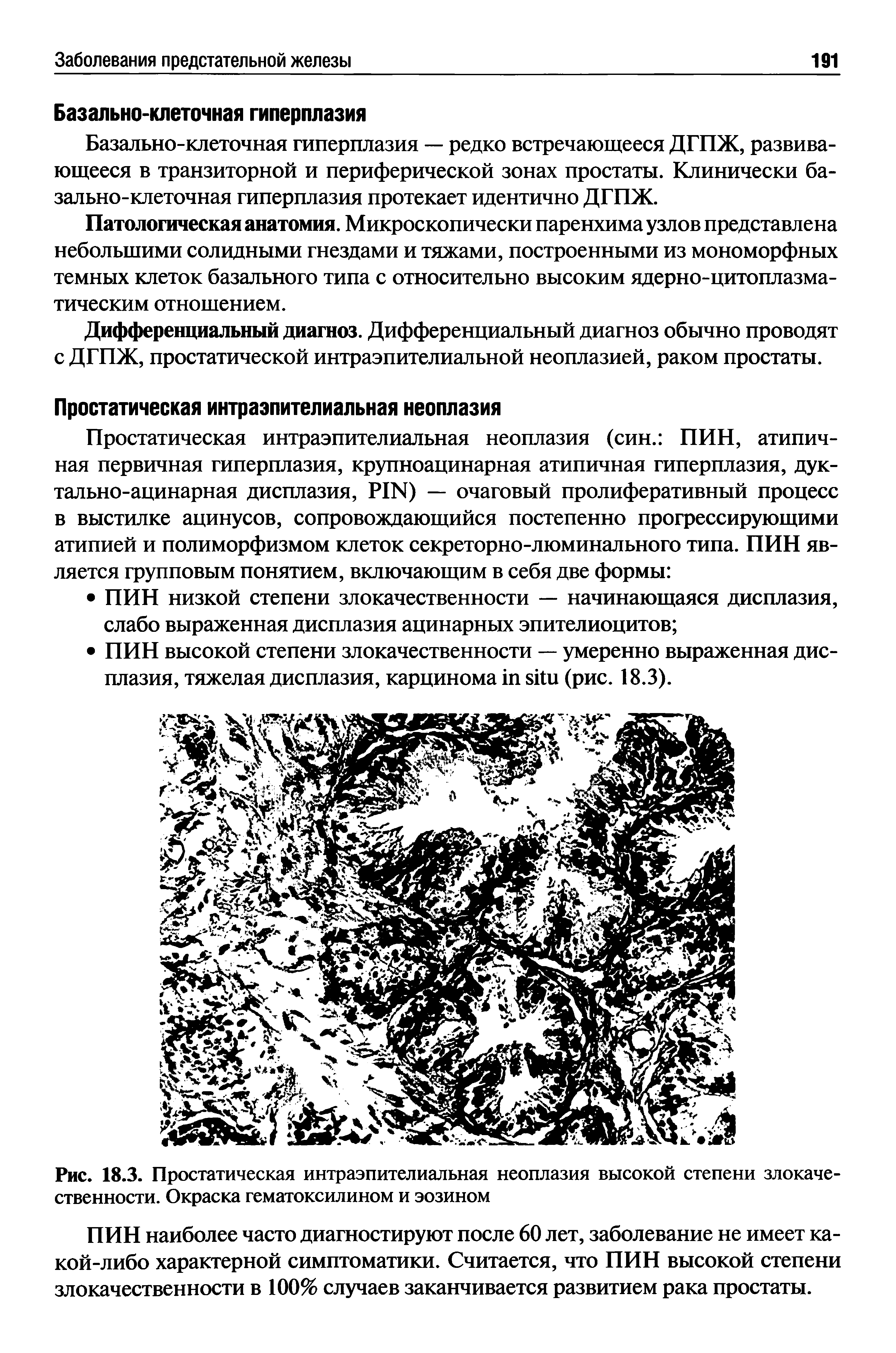 Рис. 18.3. Простатическая интраэпителиальная неоплазия высокой степени злокачественности. Окраска гематоксилином и эозином...