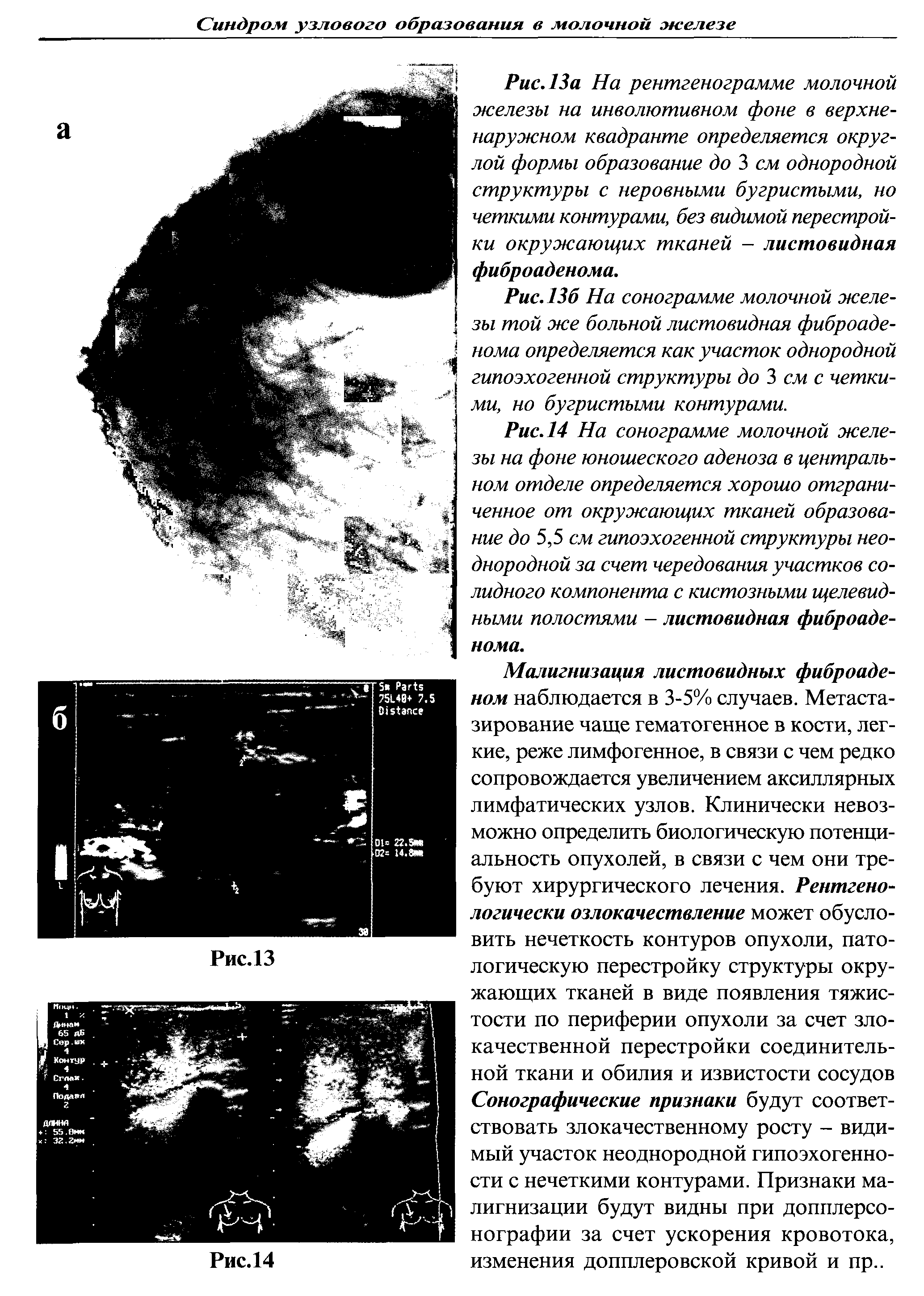 Рис. 13а На рентгенограмме молочной железы на инволютивном фоне в верхненаружном квадранте определяется округлой формы образование до 3 см однородной структуры с неровными бугристыми, но четкими контурами, без видимой перестройки окружающих тканей - листовидная фиброаденома.