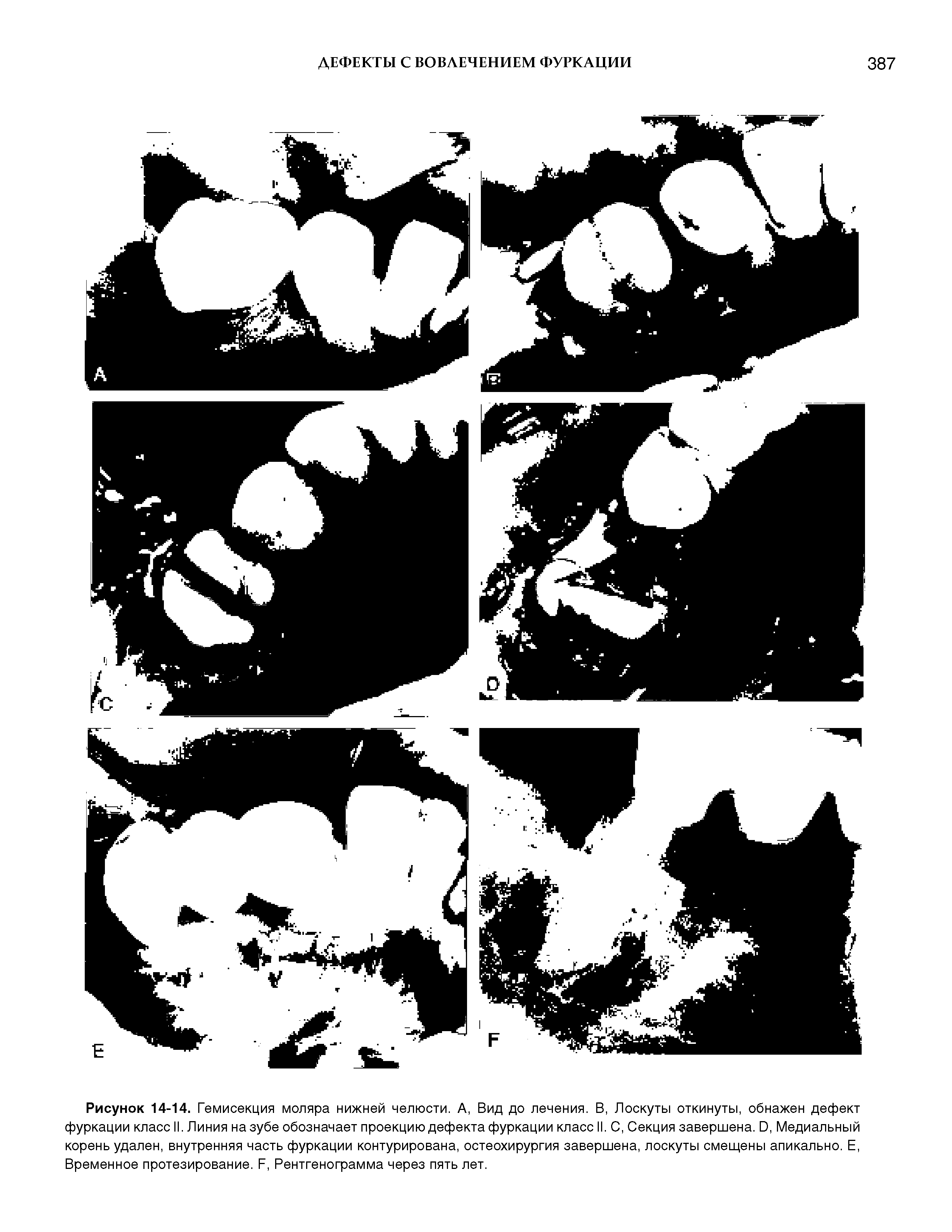 Рисунок 14-14. Гемисекция моляра нижней челюсти. А, Вид до лечения. В, Лоскуты откинуты, обнажен дефект фуркации класс II. Линия на зубе обозначает проекцию дефекта фуркации класс II. С, Секция завершена. О, Медиальный корень удален, внутренняя часть фуркации контурирована, остеохирургия завершена, лоскуты смещены апикально. Е, Временное протезирование. Л, Рентгенограмма через пять лет.