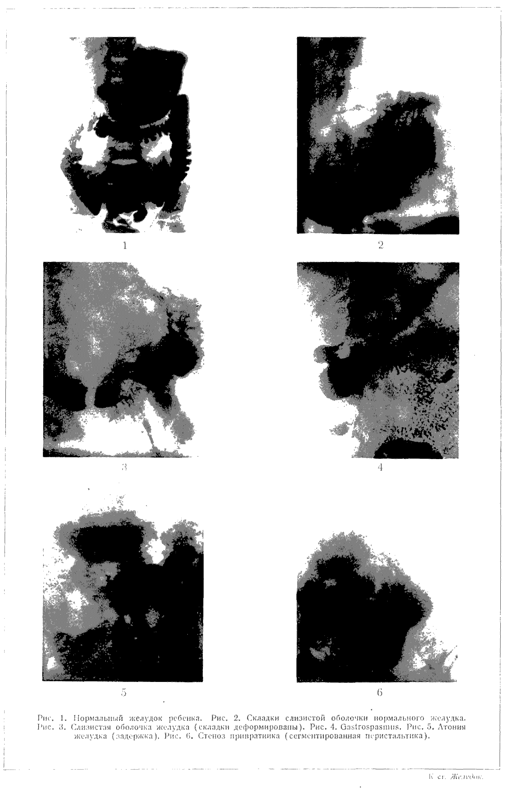 Рис. 3. Слизистая оболочка желудка (складки деформированы). Рис. 4. СтСозрайппкч. Рис. 5. Атония желудка (задержка). Рис. 6. Стеноз привратника (сегментированная перистальтика).