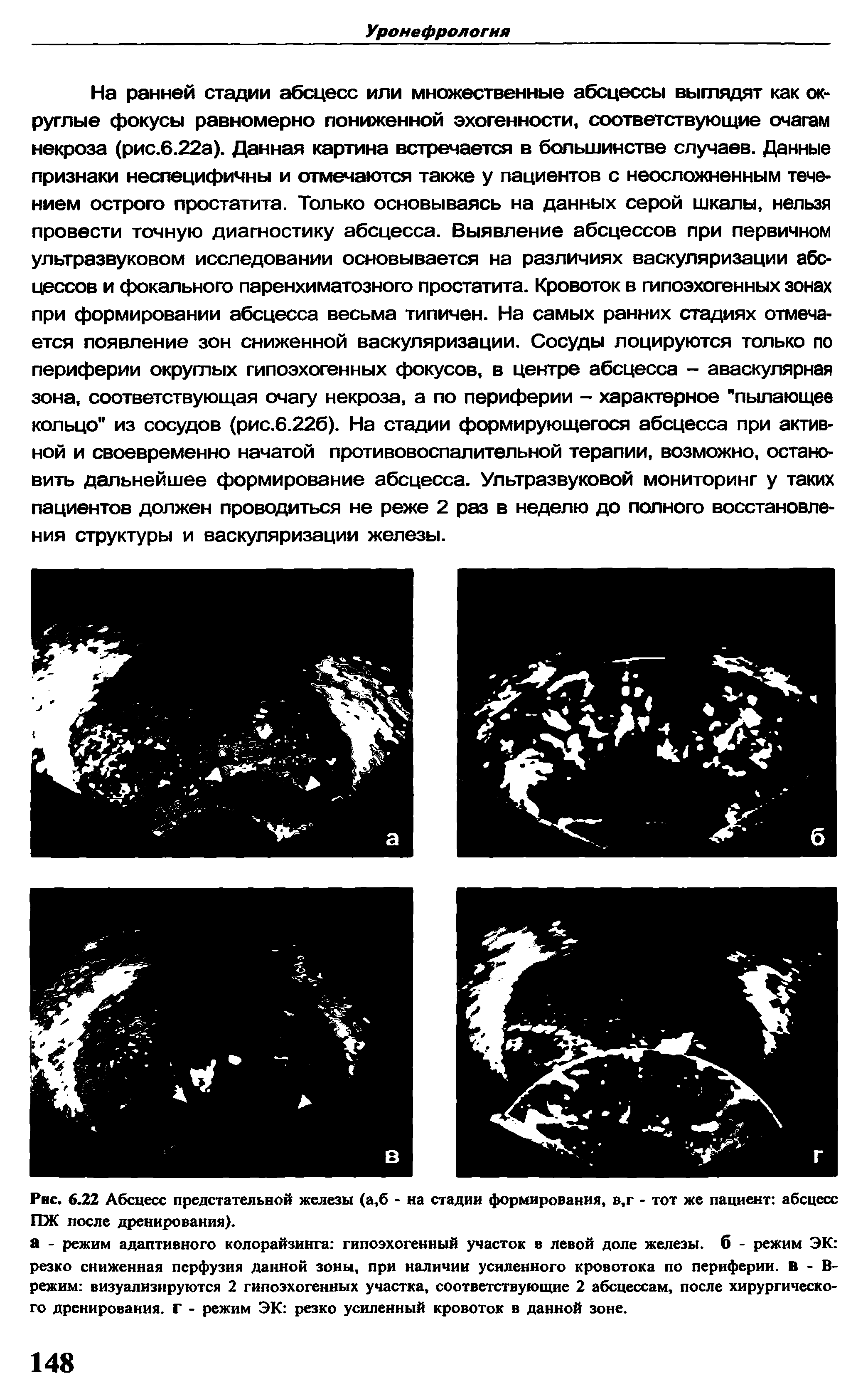 Рис. 6.22 Абсцесс предстательной железы (а,б - на стадии формирования, в,г - тот же пациент абсцесс ПЖ после дренирования).