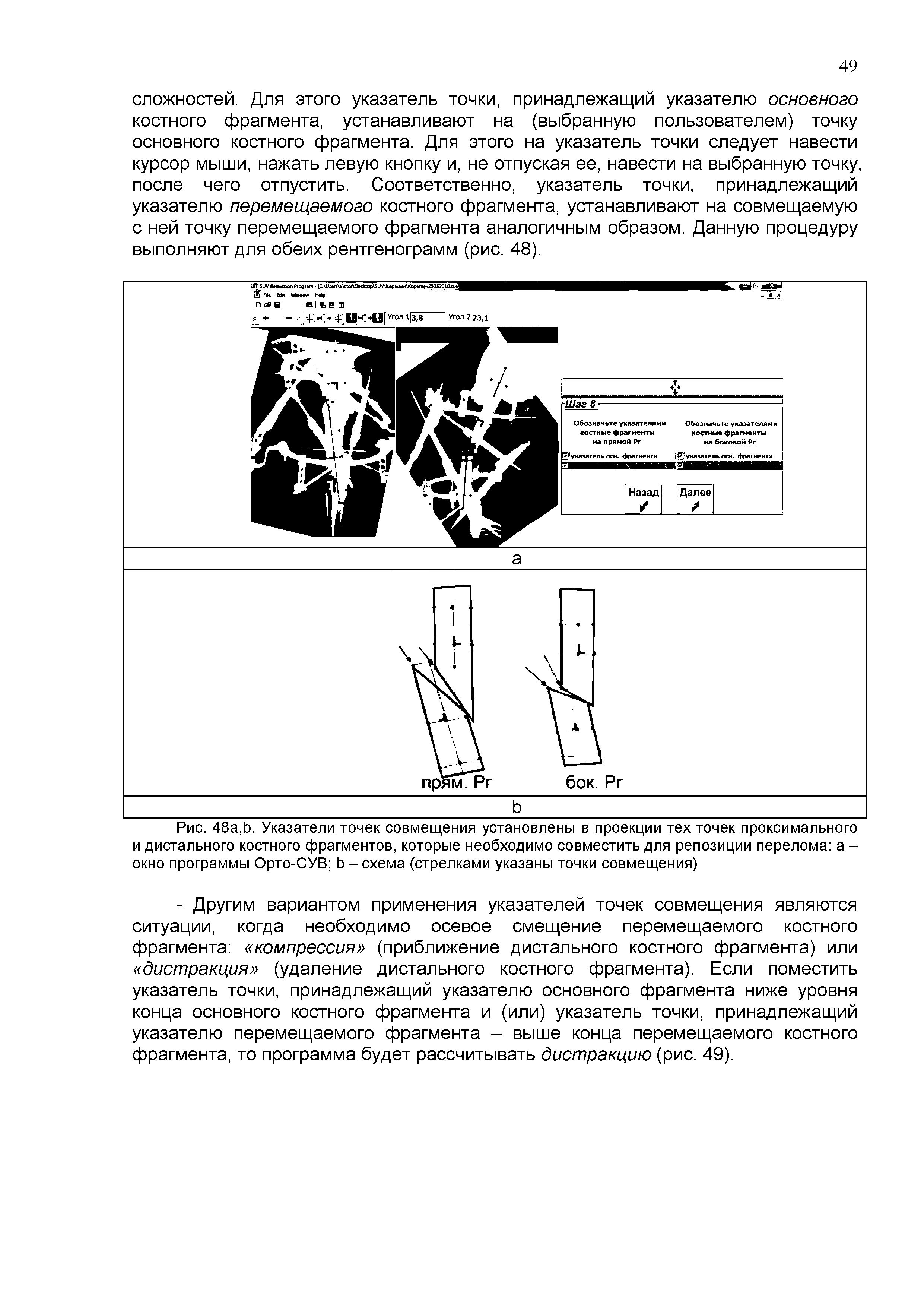 Рис. 48а,Ь. Указатели точек совмещения установлены в проекции тех точек проксимального и дистального костного фрагментов, которые необходимо совместить для репозиции перелома а -окно программы Орто-СУВ Ь - схема (стрелками указаны точки совмещения)...