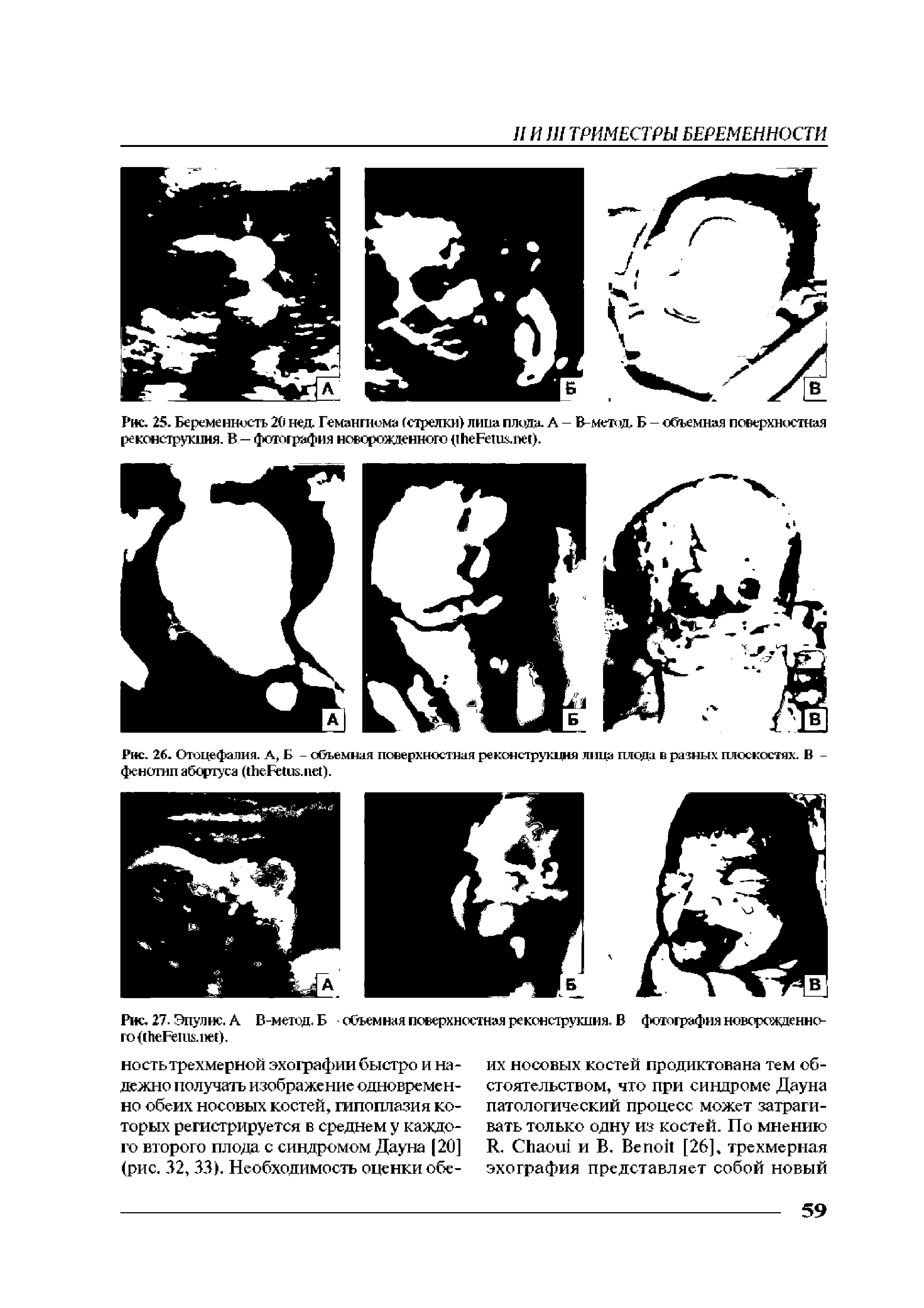 Рис. 26. Отоцефалия. А, Б - объемная поверхностная реконструкция лица плода в разных плоскостях. В -фенотип абортуса ( F . ).