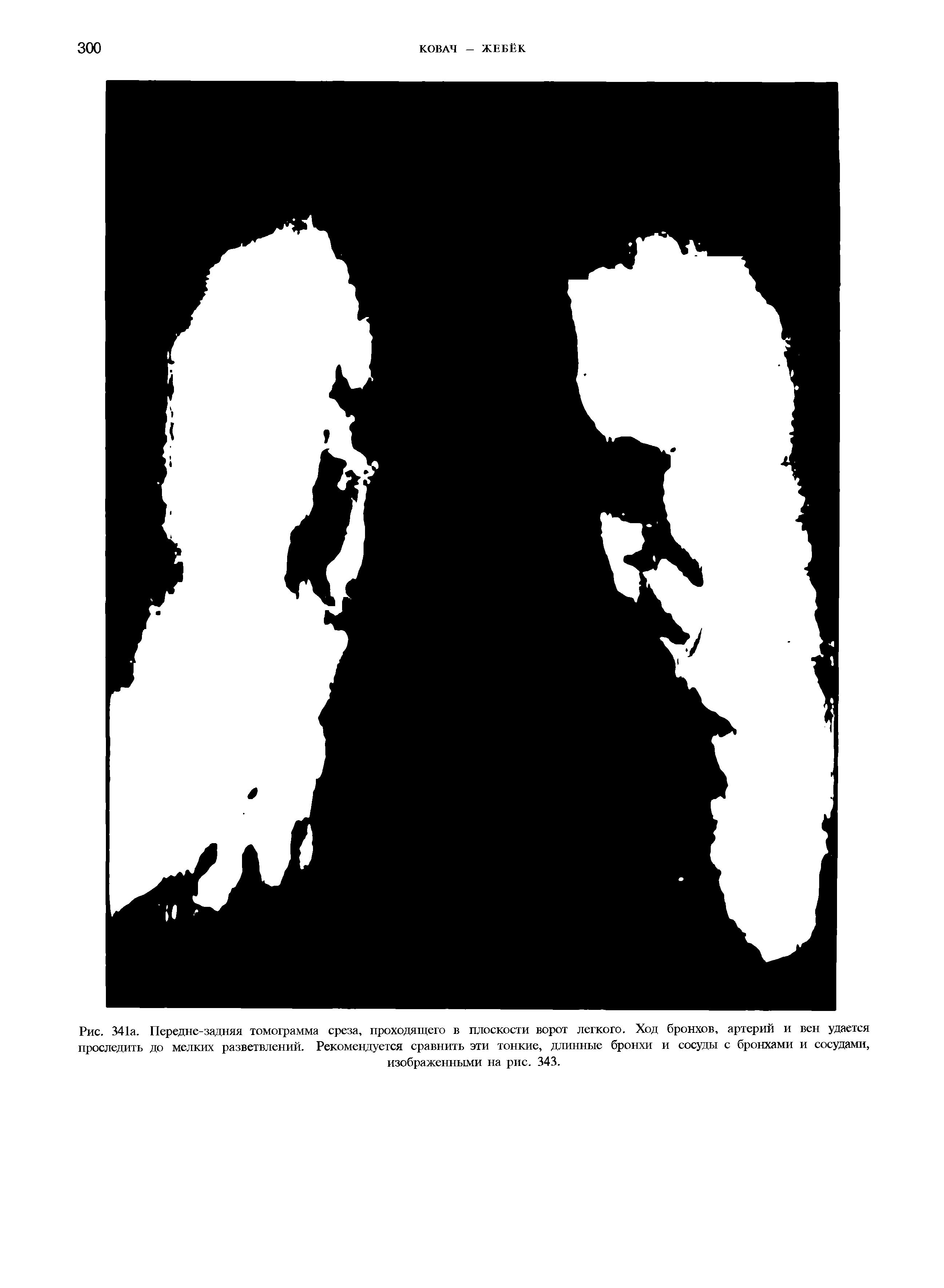 Рис. 341а. Передне-задняя томограмма среза, проходящего в плоскости ворот легкого. Ход бронхов, артерий и вен удается проследить до мелких разветвлений. Рекомендуется сравнить эти тонкие, длинные бронхи и сосуды с бронхами и сосудами, изображенными на рис. 343.