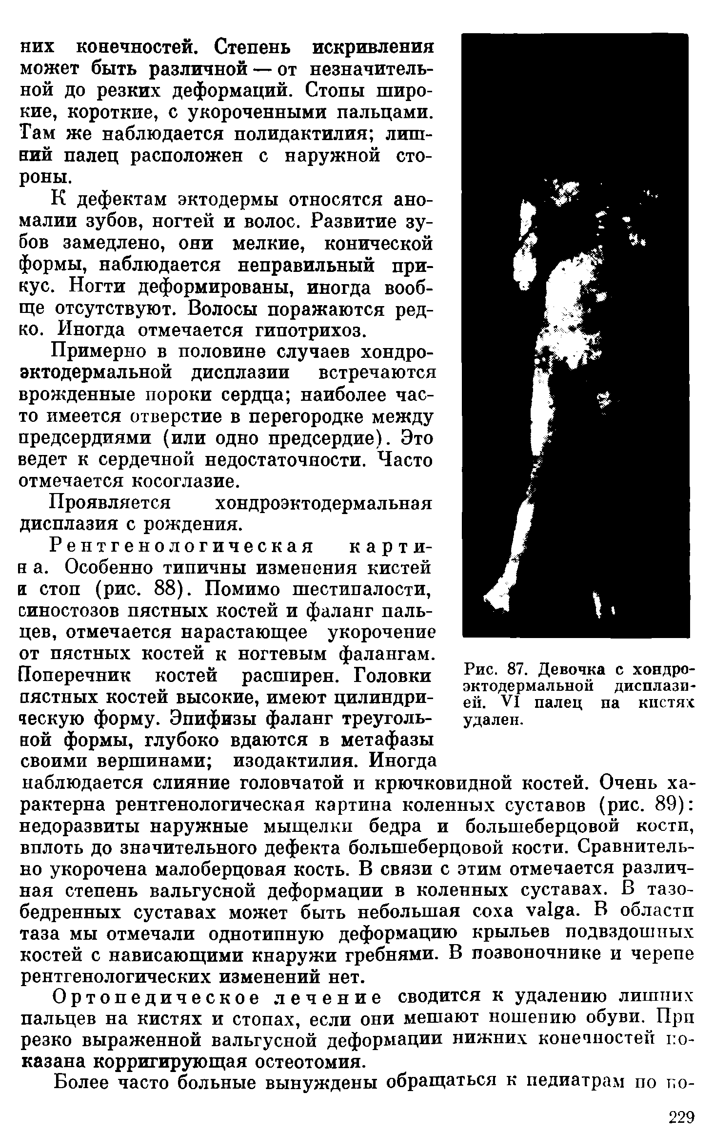 Рис. 87. Девочка с хондроэктодермальной дисплазией. VI палец па кистях удален.