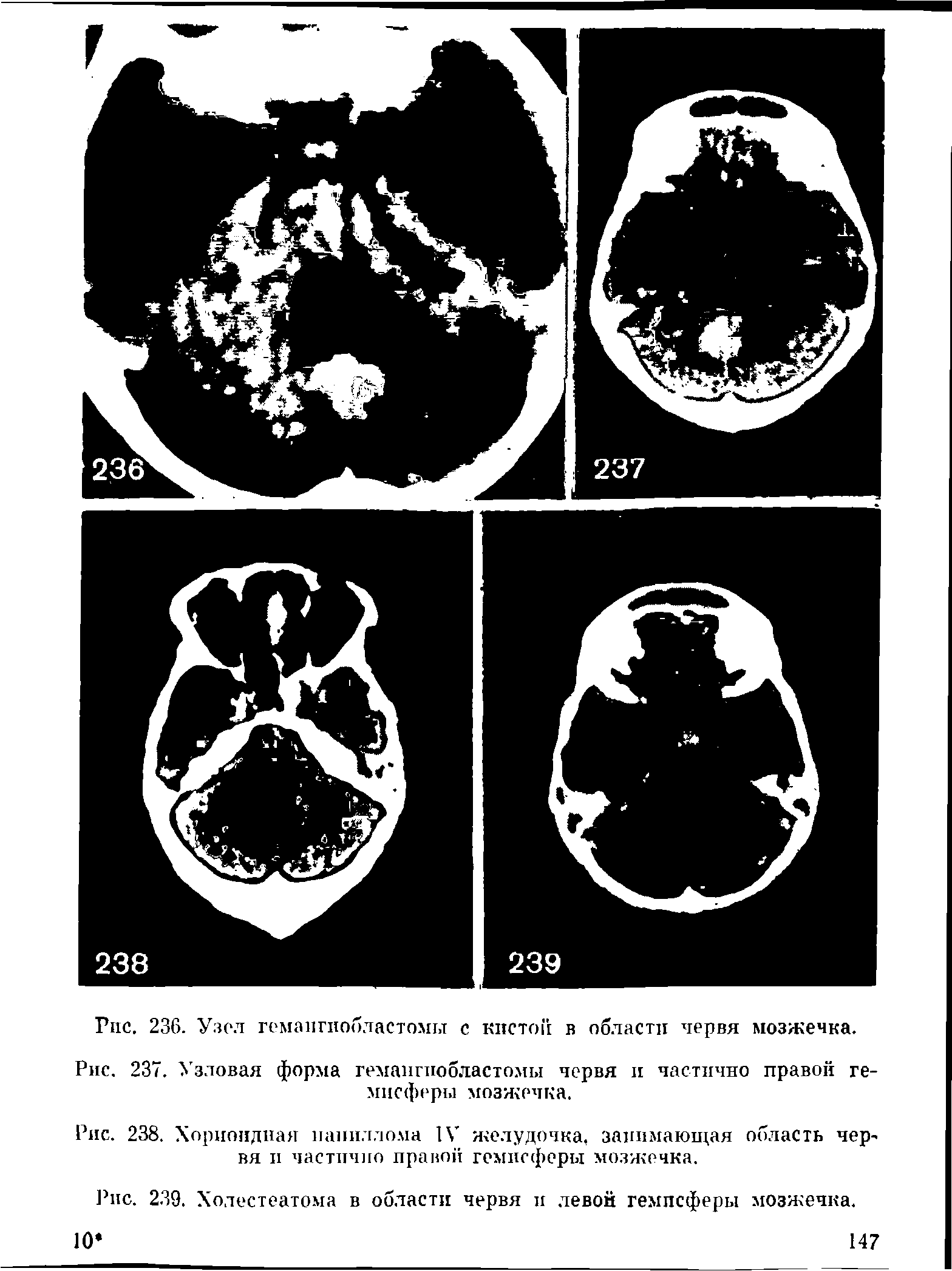 Рис. 238. Хориоидная папиллома IV желудочка, занимающая область червя и частично правой гемисферы мозжечка.