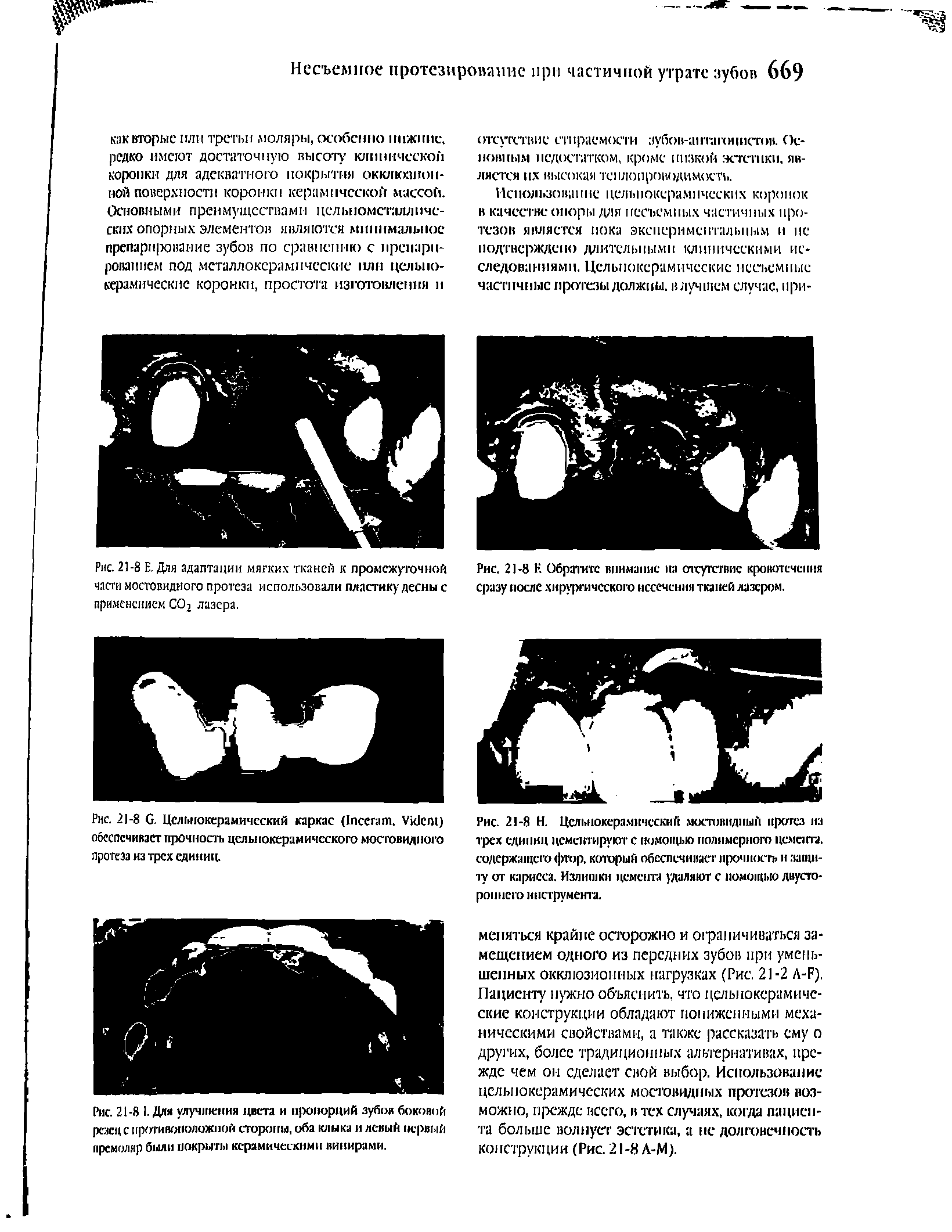 Рис. 21-8 G. Цслыюкерамический каркас (I . V ) обеспечивает прочиостъ цельнокерамического мостовидного протеза из трех единиц.