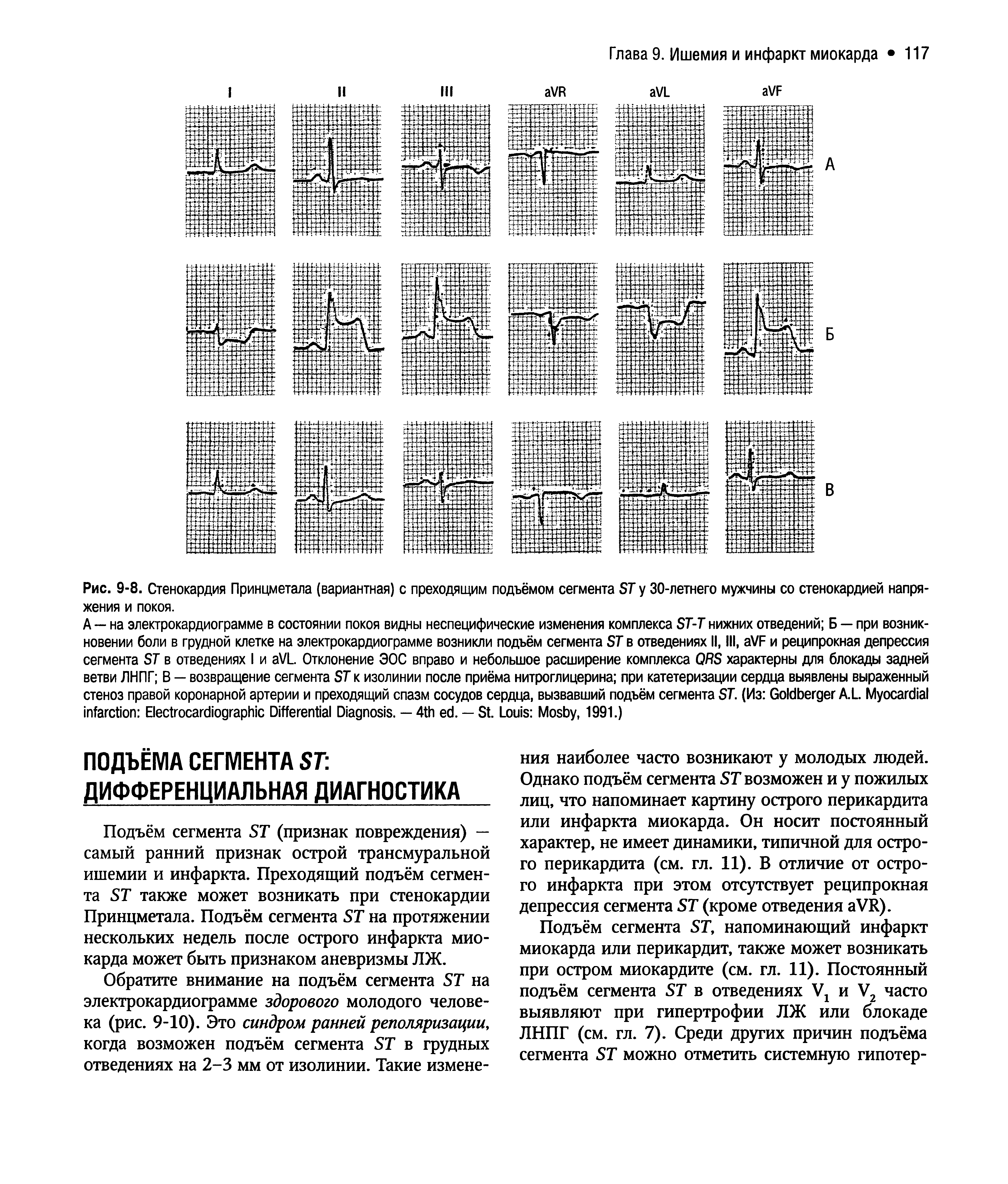 Рис. 9-8. Стенокардия Принцметала (вариантная) с преходящим подъёмом сегмента ST у 30-летнего мужчины со стенокардией напряжения и покоя.