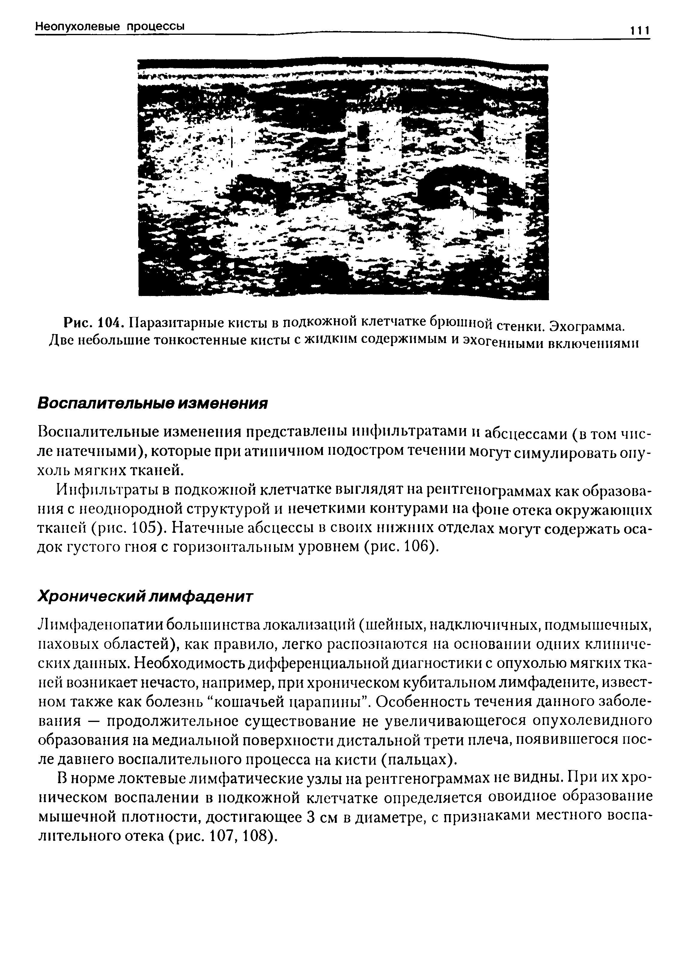 Рис. 104. Паразитарные кисты в подкожной клетчатке брюшной стенки. Эхограмма. Две небольшие тонкостенные кисты с жидким содержимым и эхогенными включениями...