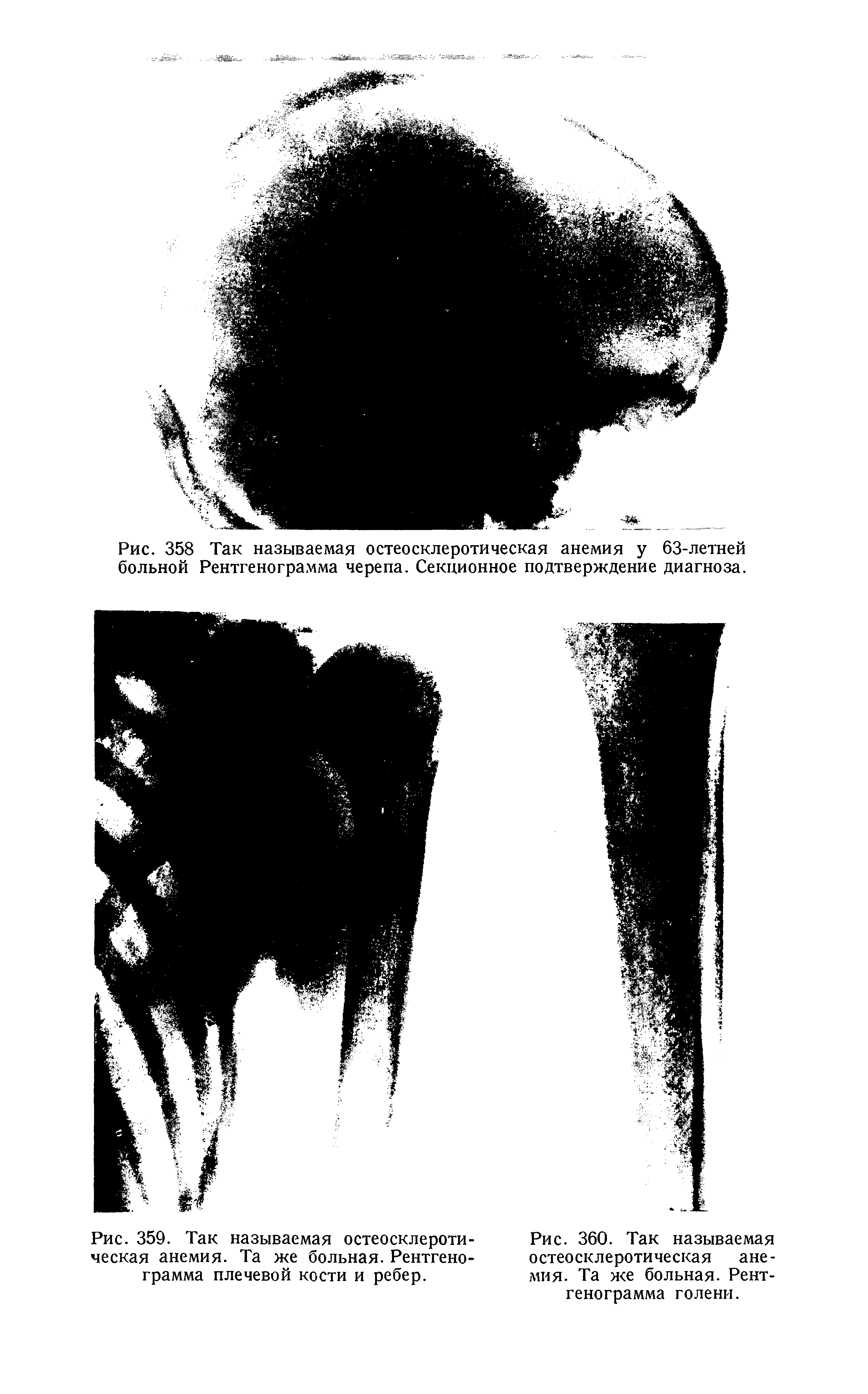 Рис. 359. Так называемая остеосклеротическая анемия. Та же больная. Рентгенограмма плечевой кости и ребер.