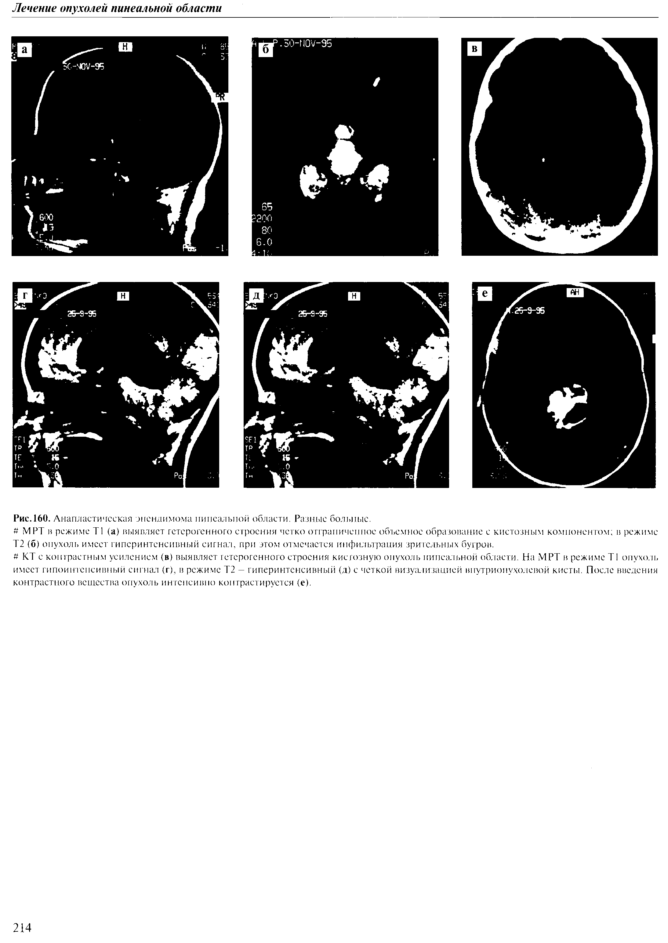 Рис.160. Анапластическая эпендимома липсалыюй области. Разные больные.