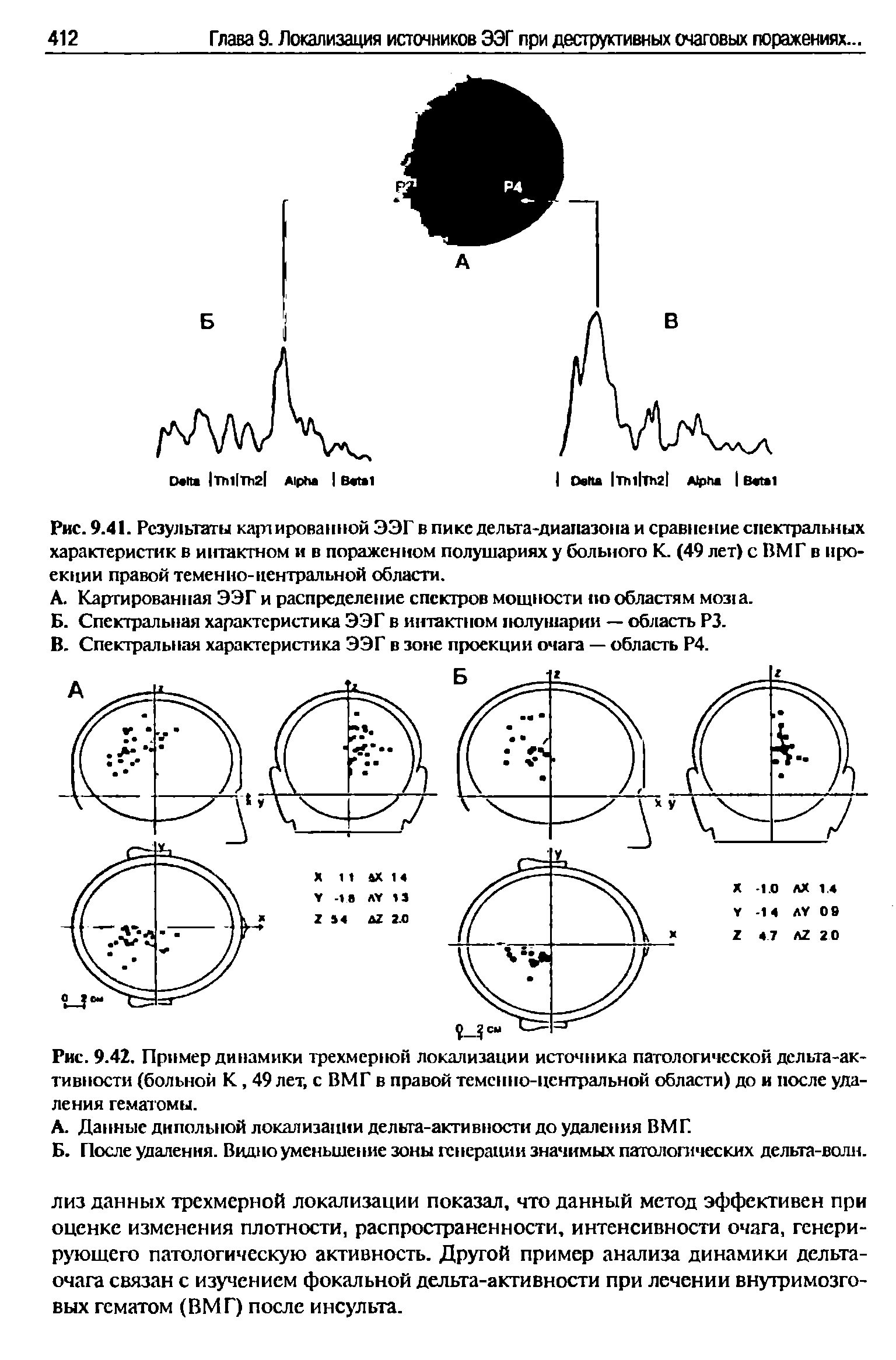 Рис. 9.42. Пример динамики трехмерной локализации источника патологической дельта-активности (больной К, 49 лет, с ВМГ в правой теменно-центральной области) до и после удаления гематомы.