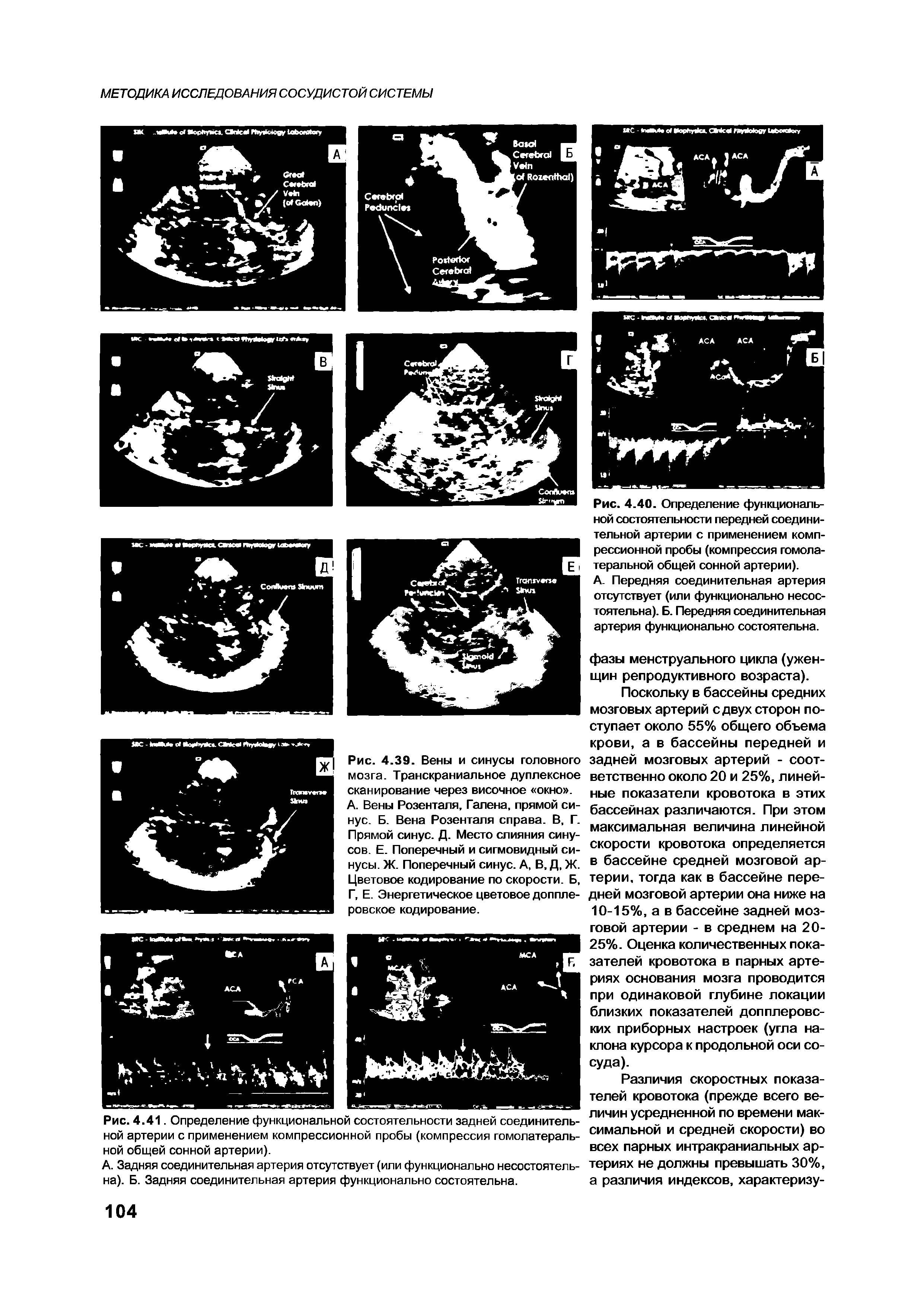 Рис. 4.39. Вены и синусы головного мозга. Транскраниальное дуплексное сканирование через височное окно .