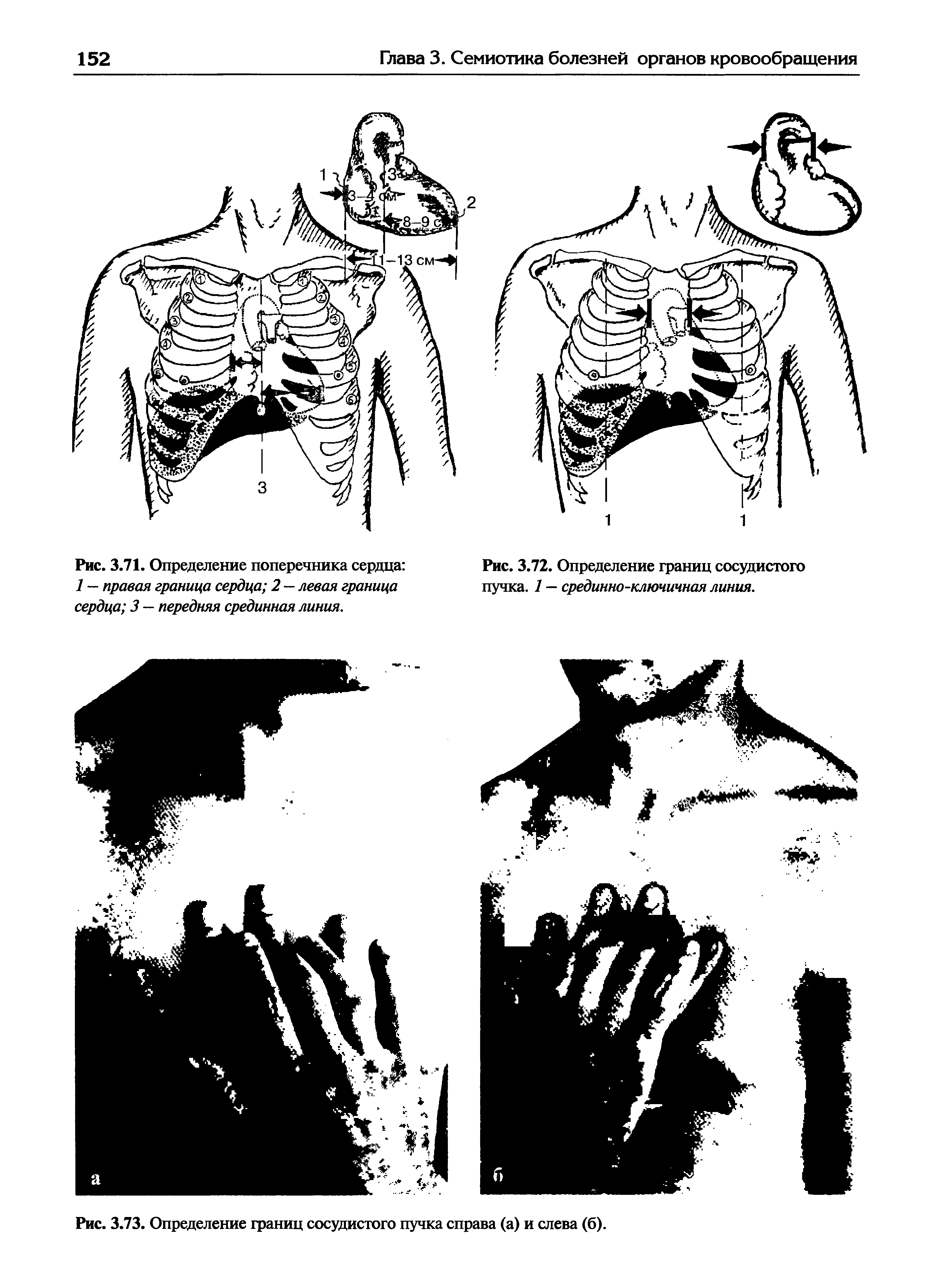 Рис. 3.73. Определение границ сосудистого пучка справа (а) и слева (б).