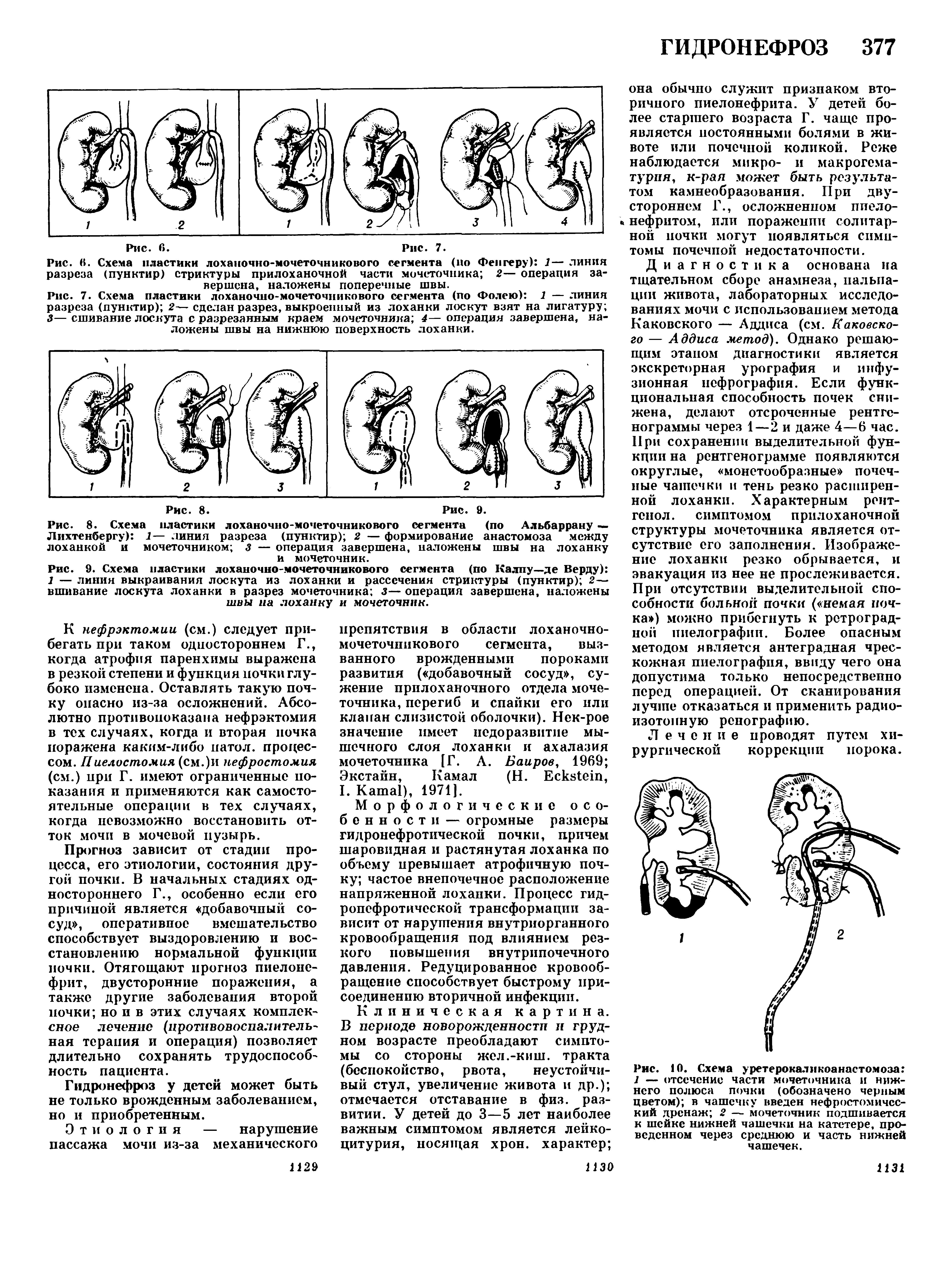 Рис. 7. Схема пластики лоханочно-мочеточникового сегмента (по Фолею) 1 — линия разреза (пунктир) 2— сделан разрез, выкроенный из лоханки лоскут взят на лигатуру 3— сшивание лоскута с разрезанным краем мочеточника 4— операция завершена, наложены швы на нижнюю поверхность лоханки.