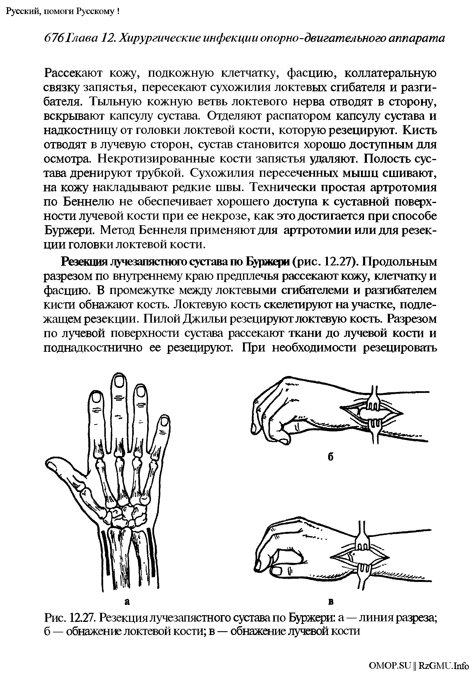 Рис. 12.27. Резекция лучезапястного сустава по Буржери а—линия разреза б — обнажение локтевой кости в — обнажение лучевой кости...