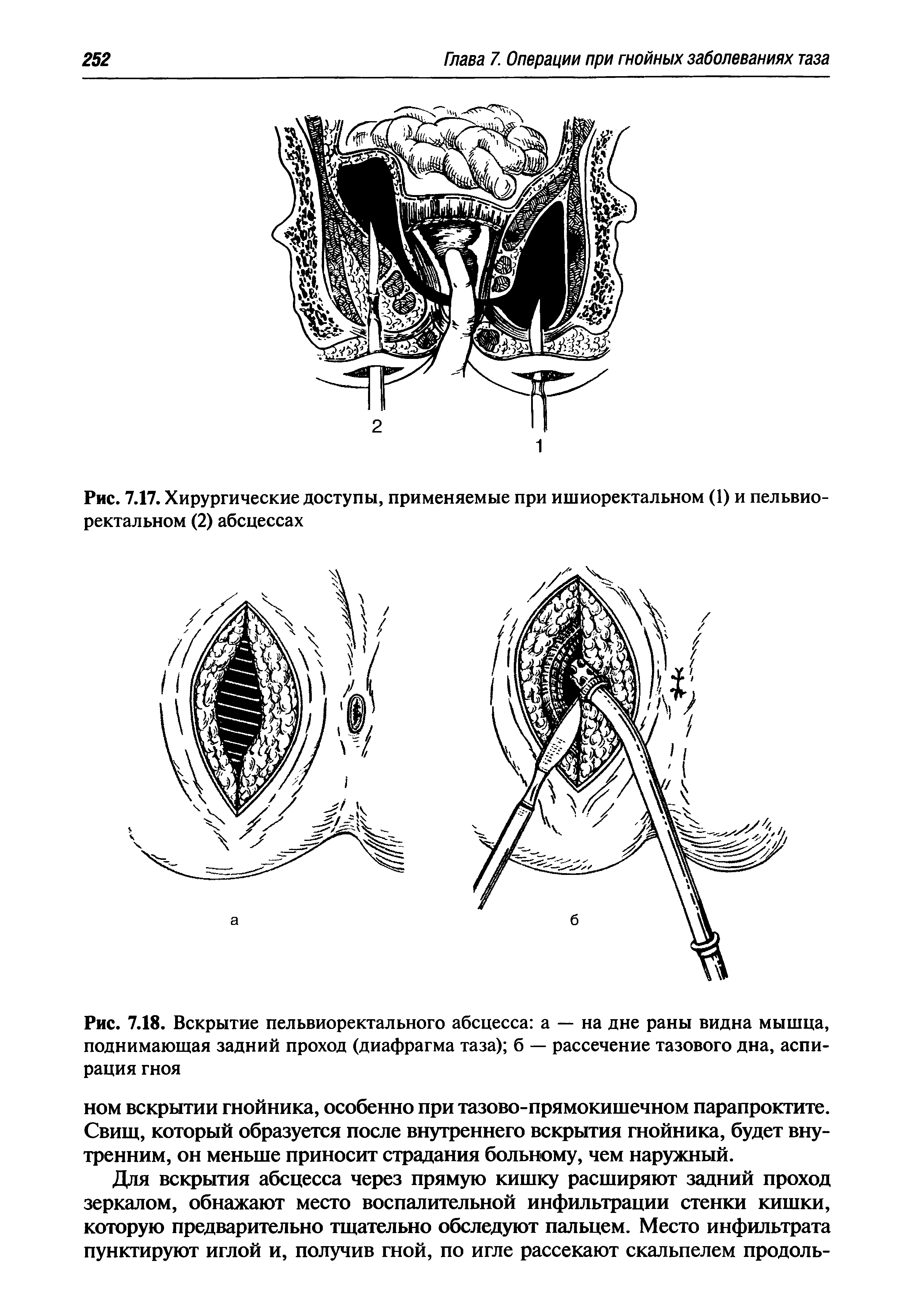 Рис. 7.18. Вскрытие пельвиоректального абсцесса а — на дне раны видна мышца, поднимающая задний проход (диафрагма таза) б — рассечение тазового дна, аспирация гноя...