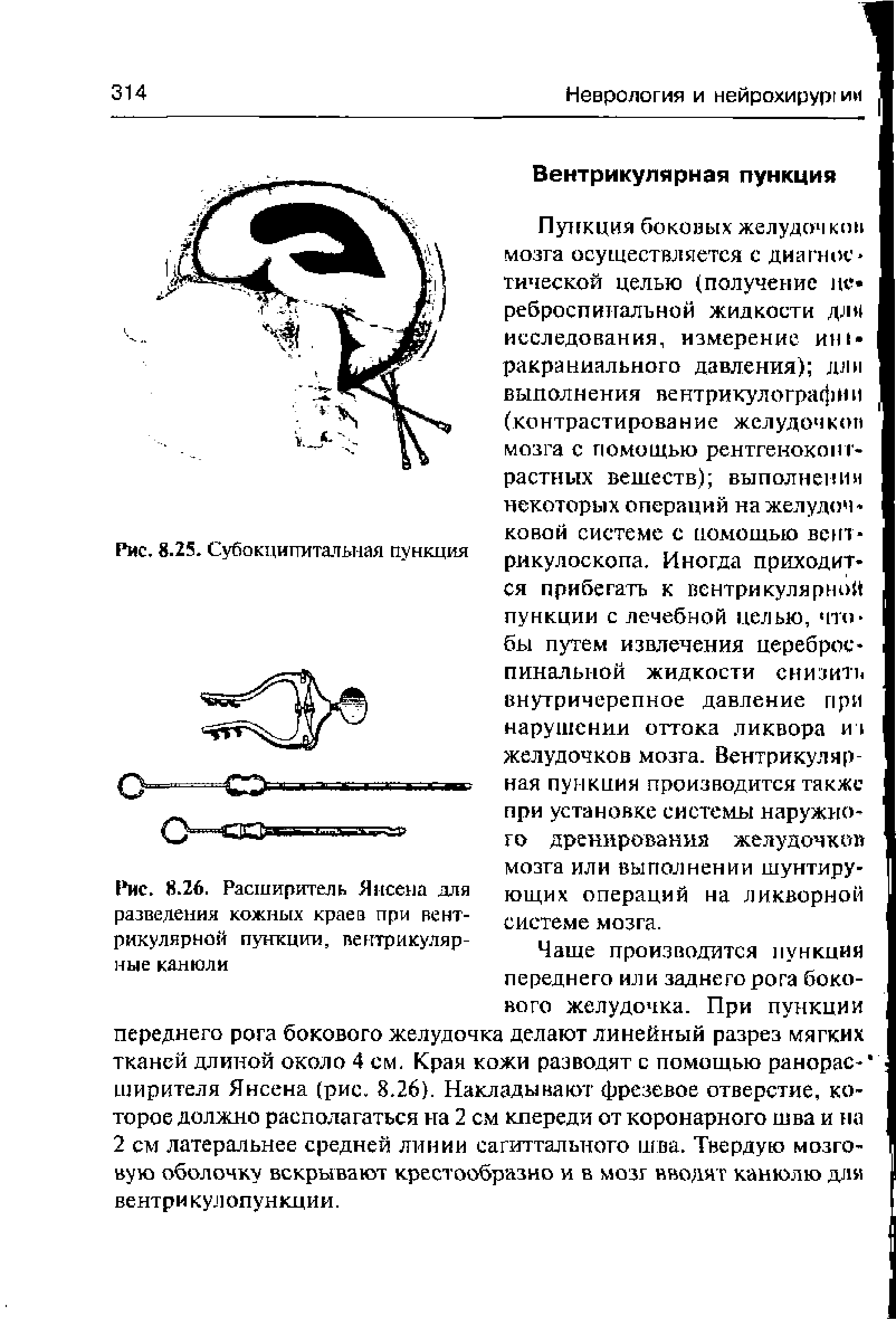 Рис. 8.26. Расширитель Янсена для разведения кожных краев при вентрикулярной пункции, вентрикулярные канюли...