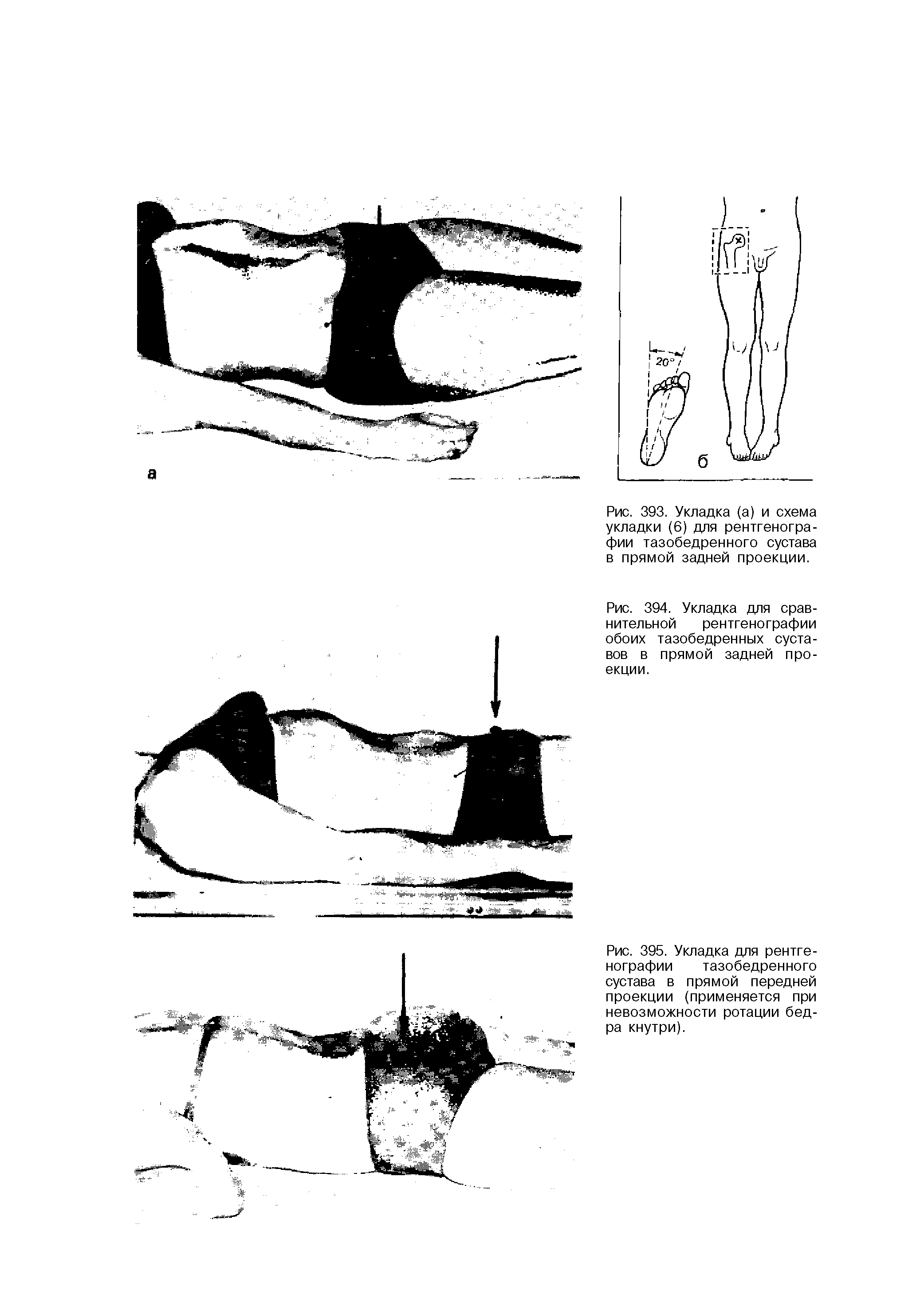 Рис. 394. Укладка для сравнительной рентгенографии обоих тазобедренных суставов в прямой задней проекции.