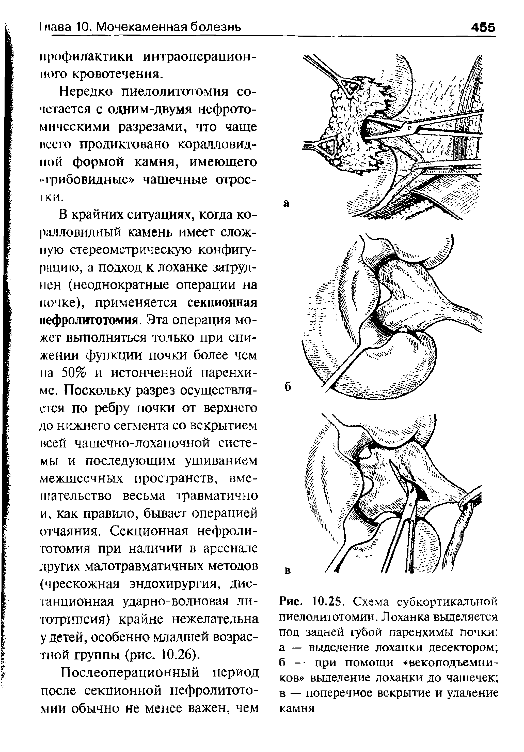 Рис. 10.25. Схема субкортикальной пиелолитотомии. Лоханка выделяется под задней губой паренхимы почки а — выделение лоханки десектором б — при помощи векоподъем ников выделение лоханки до чашечек в — поперечное вскрытие и удаление камня...