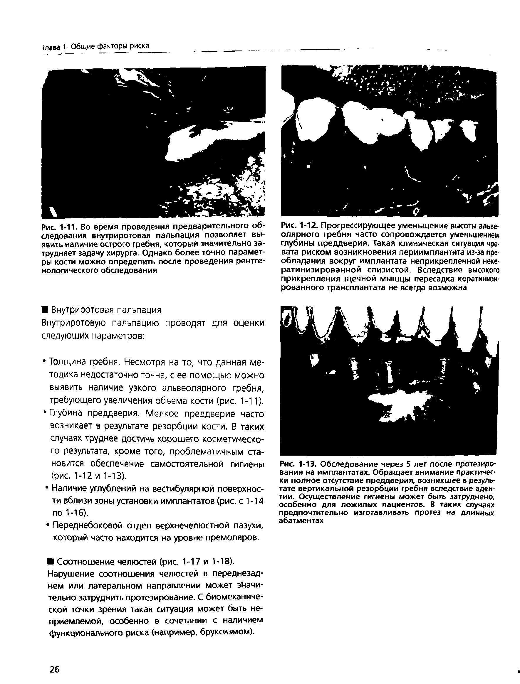 Рис. 1-13. Обследование через 5 лет после протезирования на имплантатах. Обращает внимание практически полное отсутствие преддверия, возникшее в результате вертикальной резорбции гребня вследствие аден-тии. Осуществление гигиены может быть затруднено, особенно для пожилых пациентов. В таких случаях предпочтительно изготавливать протез на длинных абатментах...