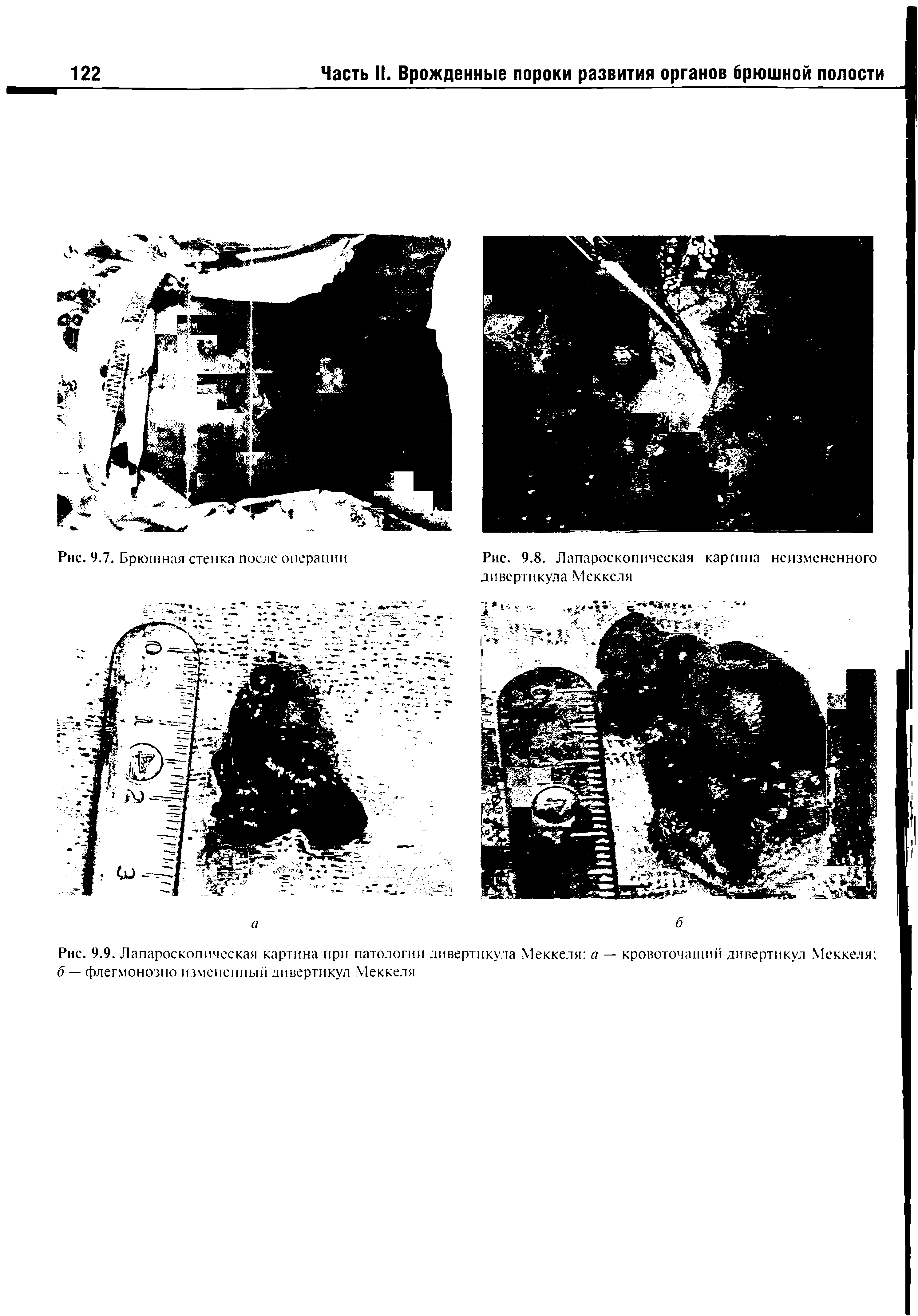 Рис. 9.9. Лапароскопическая картина при патологии дивертикула Меккеля а — кровоточащий дивертикул Меккеля б — флегмонозно измененный дивертикул Меккеля...