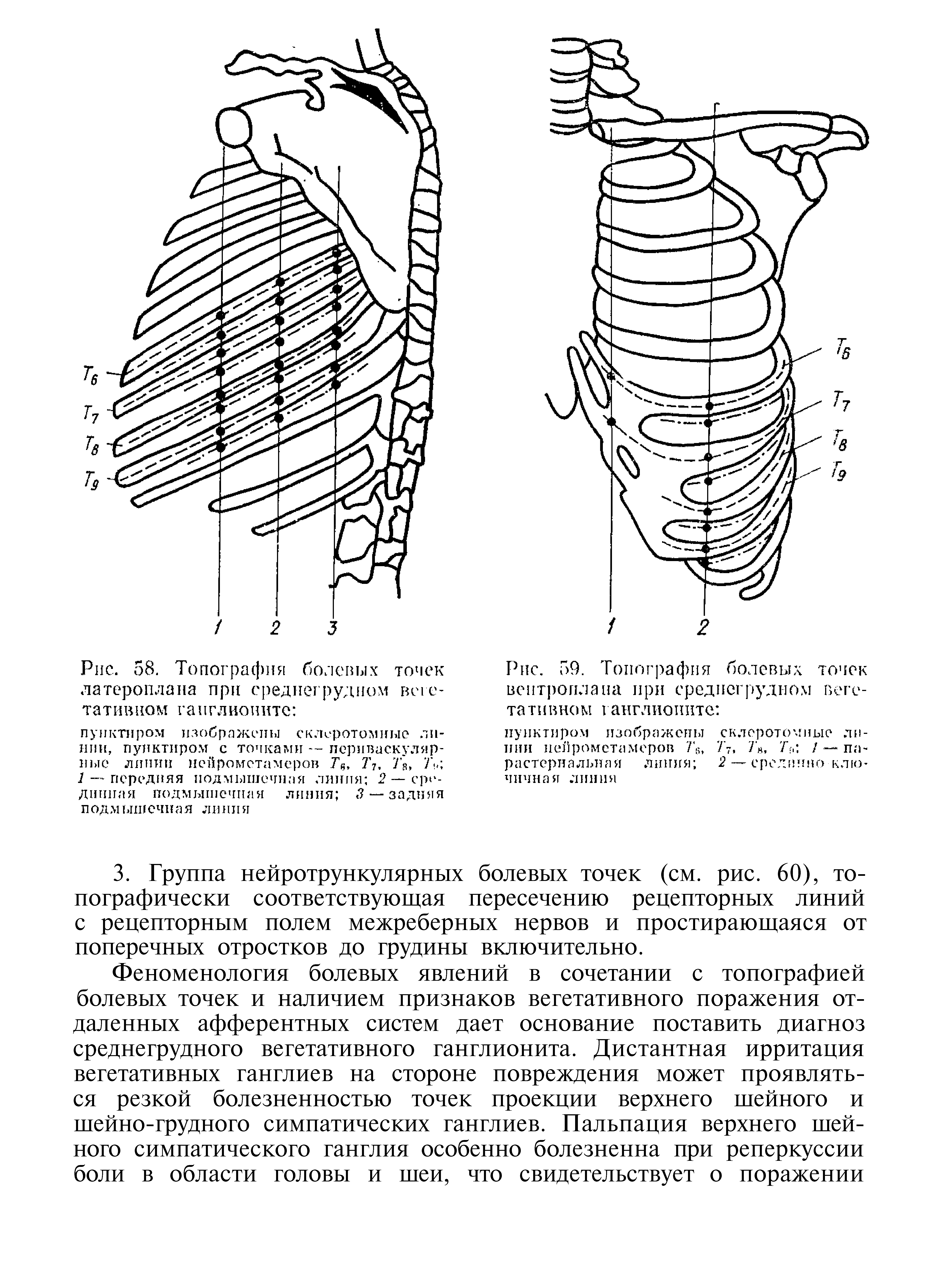 Рис. 59. Топография болевых точек вентроплана при среднегрудном вегетативном ганглионите ...