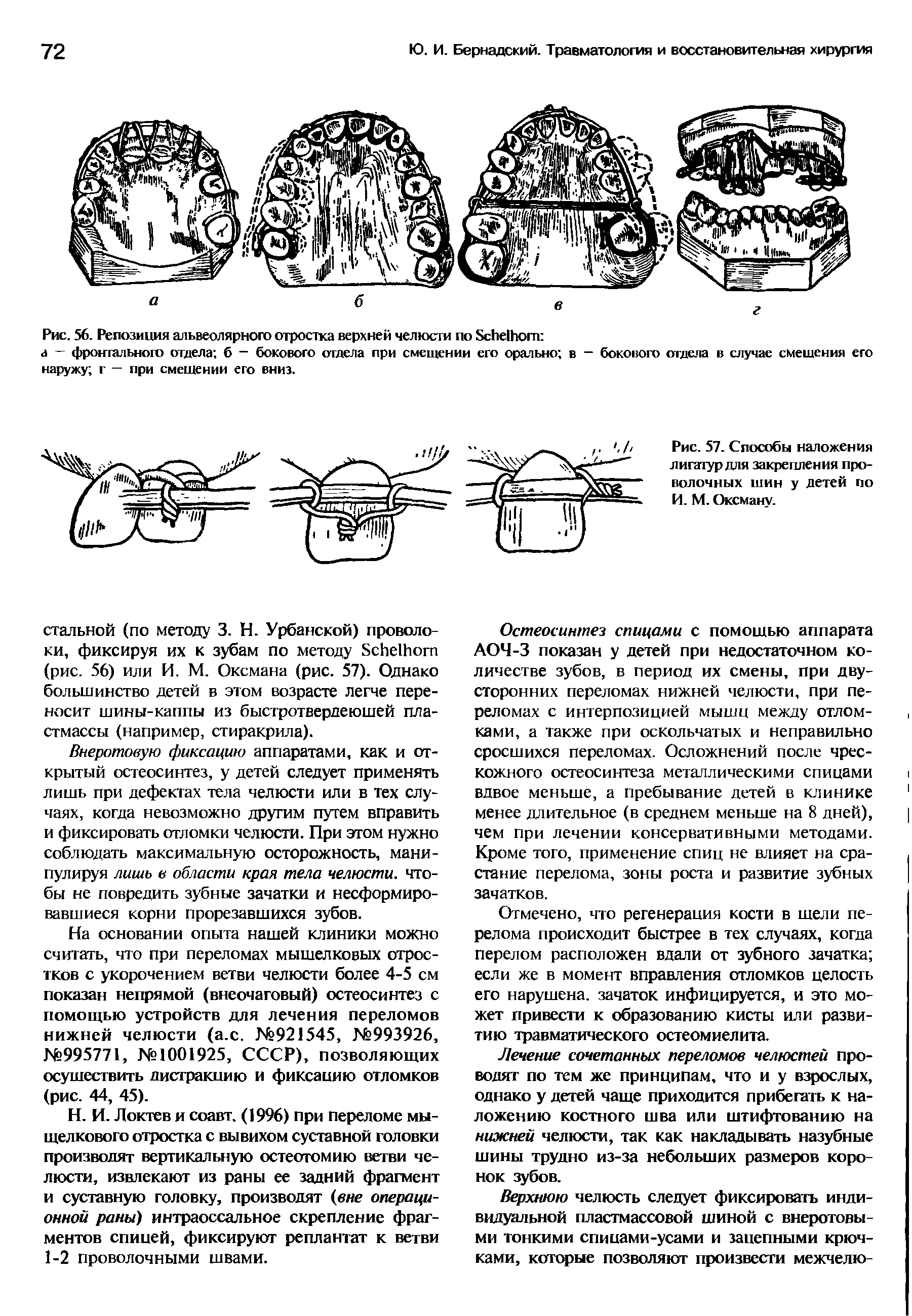 Рис. 57. Способы наложения лигатур для закрепления проволочных шин у детей по И. М. Оксману.