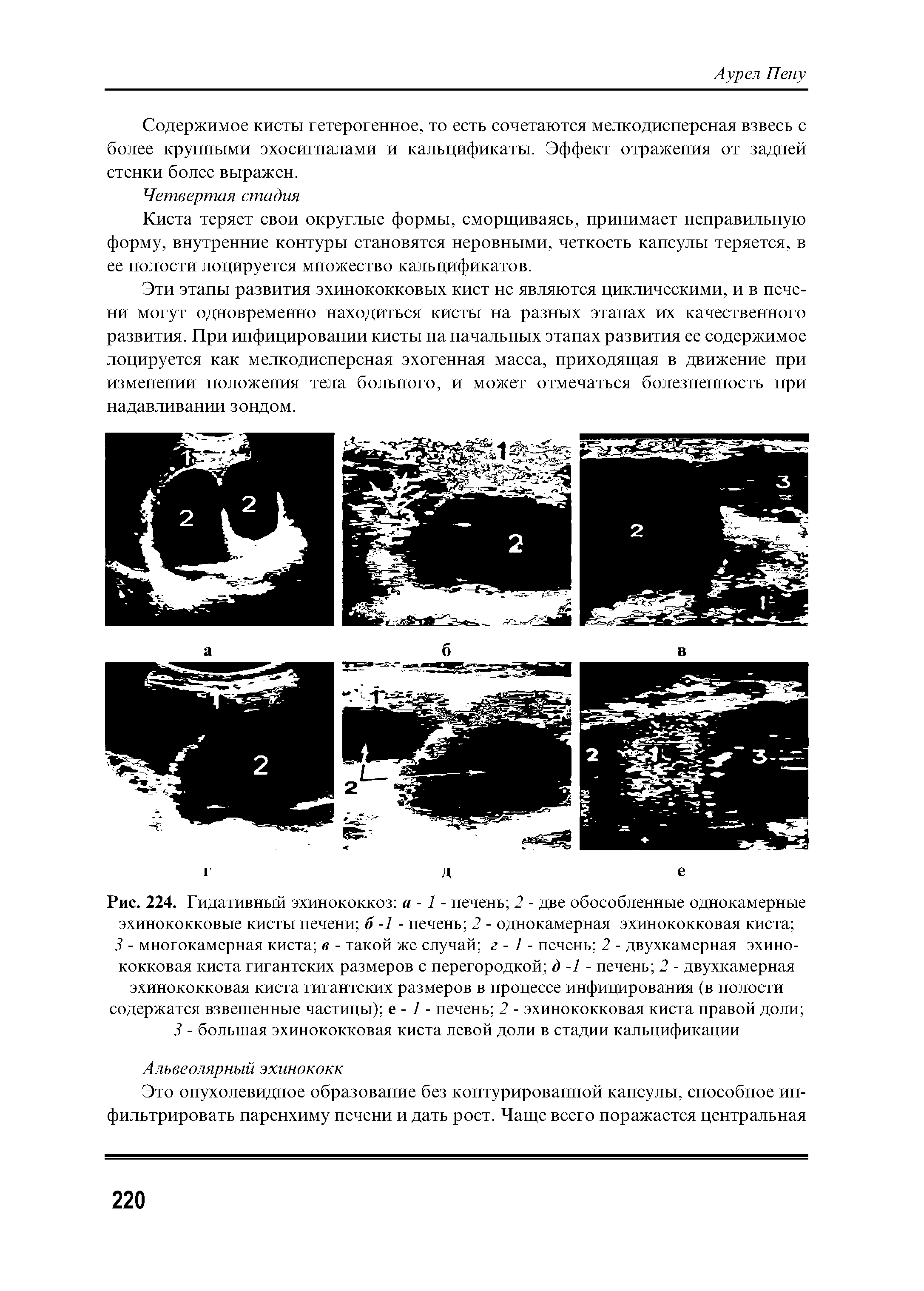 Рис. 224. Гидативный эхинококкоз а - 1 - печень 2 - две обособленные однокамерные эхинококковые кисты печени б -1 - печень 2 - однокамерная эхинококковая киста ...