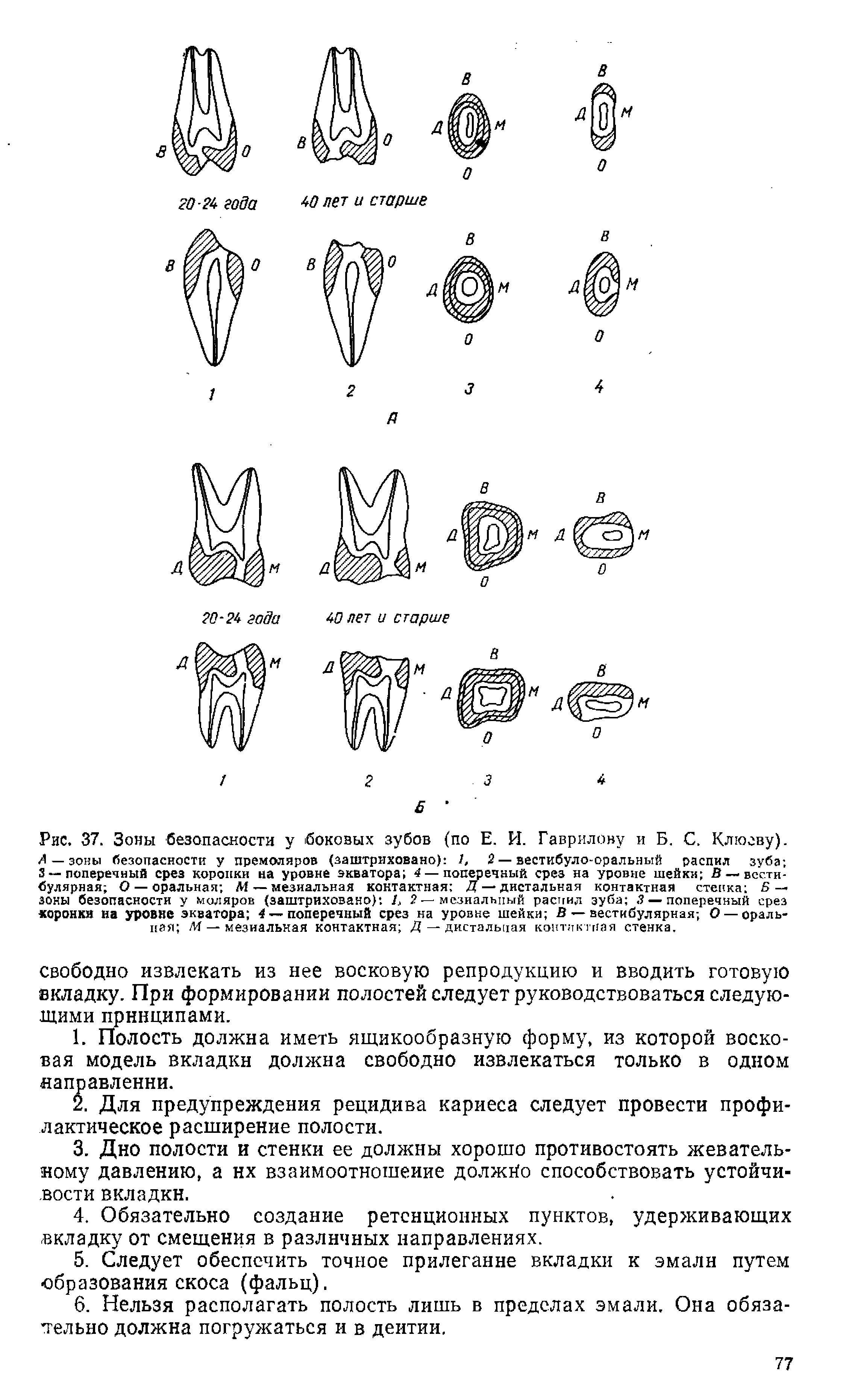 Рис. 37. Зоны безопасности у боковых зубов (по Е. И. Гаврилову и Б. С. Клюеву). Л — зоны безопасности у премоляров (заштриховано) 1, 2 — вестибуло-оральный распил зуба ...