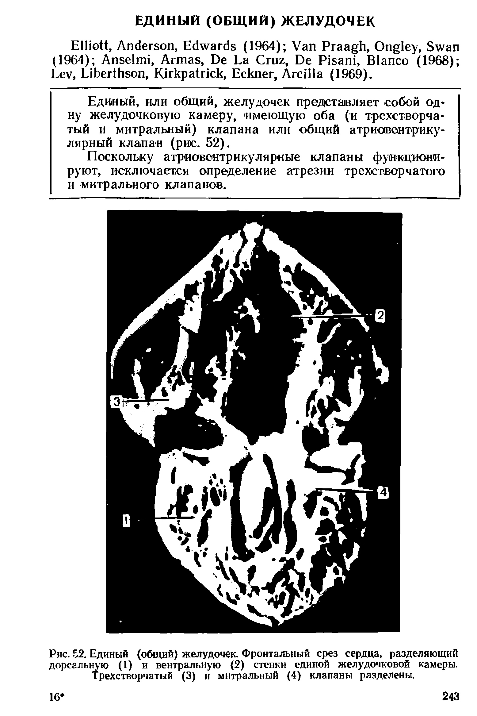 Рис. 52. Единый (общий) желудочек. Фронтальный срез сердца, разделяющий дорсальную (1) и вентральную (2) стенки единой желудочковой камеры. Трехстворчатый (3) и митральный (4) клапаны разделены.