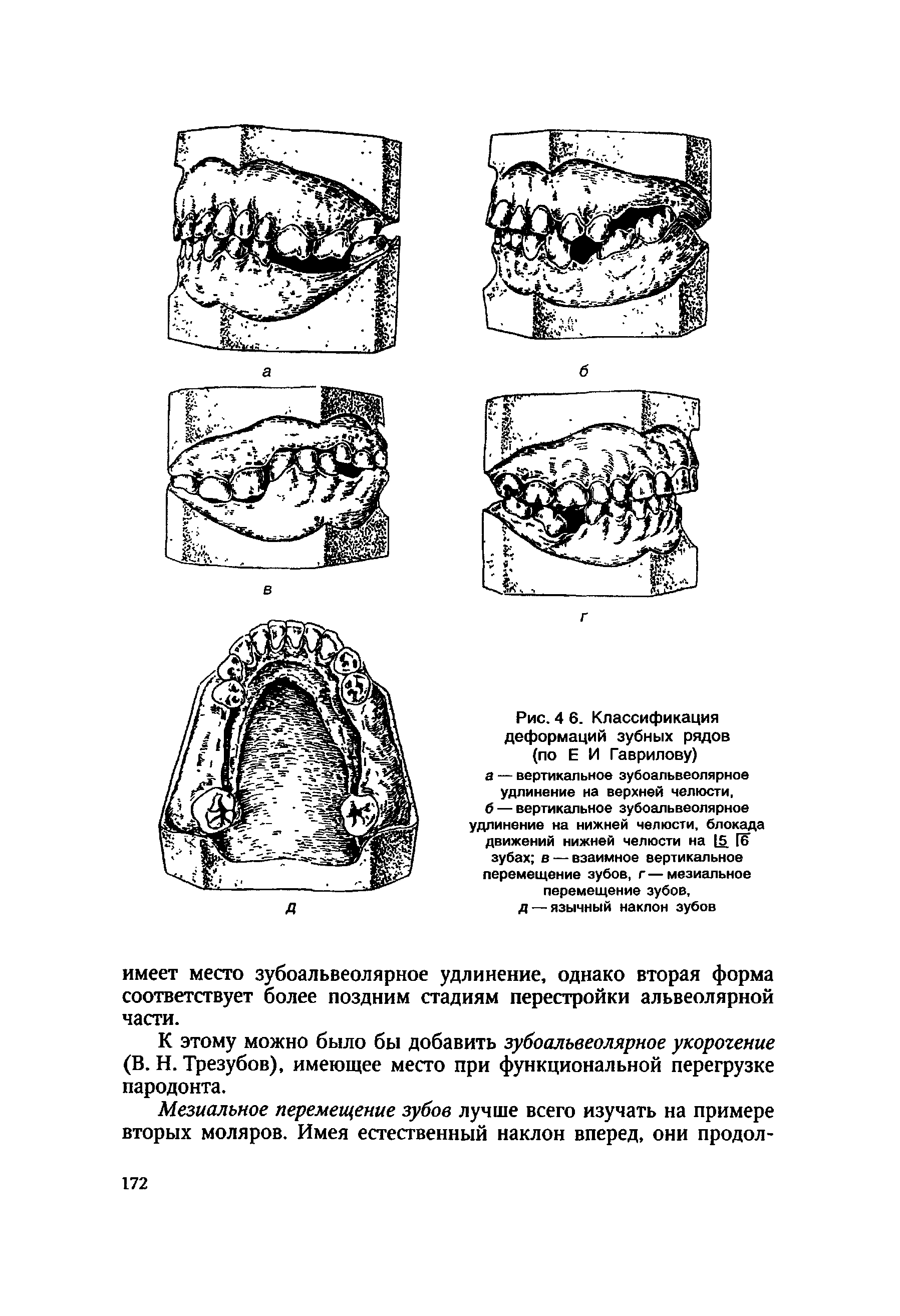 Рис. 4 6. Классификация деформаций зубных рядов (по Е И Гаврилову) а — вертикальное зубоальвеолярное удлинение на верхней челюсти, б — вертикальное зубоальвеолярное удлинение на нижней челюсти, блокада движений нижней челюсти на 15 [6 зубах в — взаимное вертикальное перемещение зубов, г—мезиальное перемещение зубов, д — язычный наклон зубов...