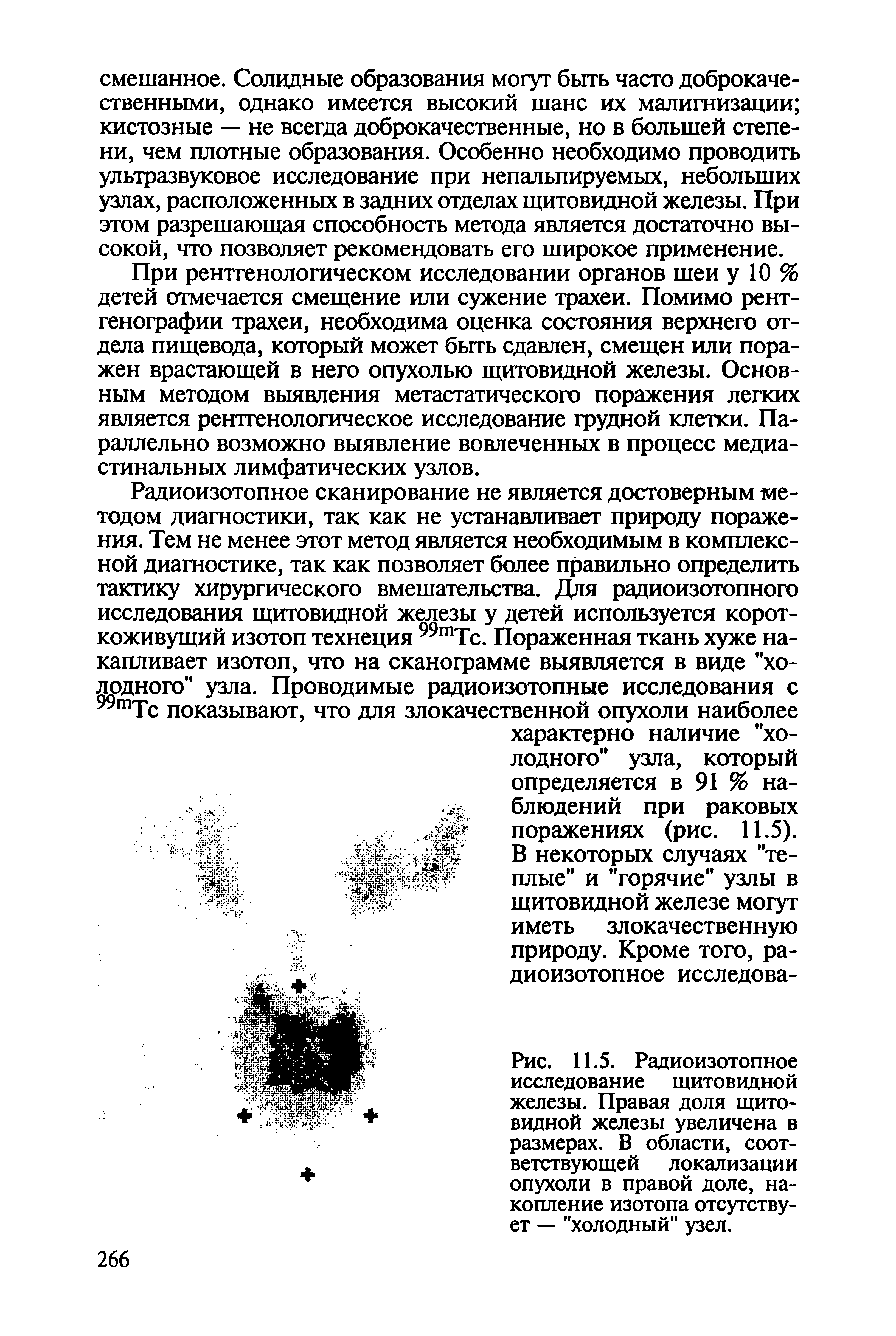 Рис. 11.5. Радиоизотопное исследование щитовидной железы. Правая доля щитовидной железы увеличена в размерах. В области, соответствующей локализации опухоли в правой доле, накопление изотопа отсутствует — "холодный" узел.