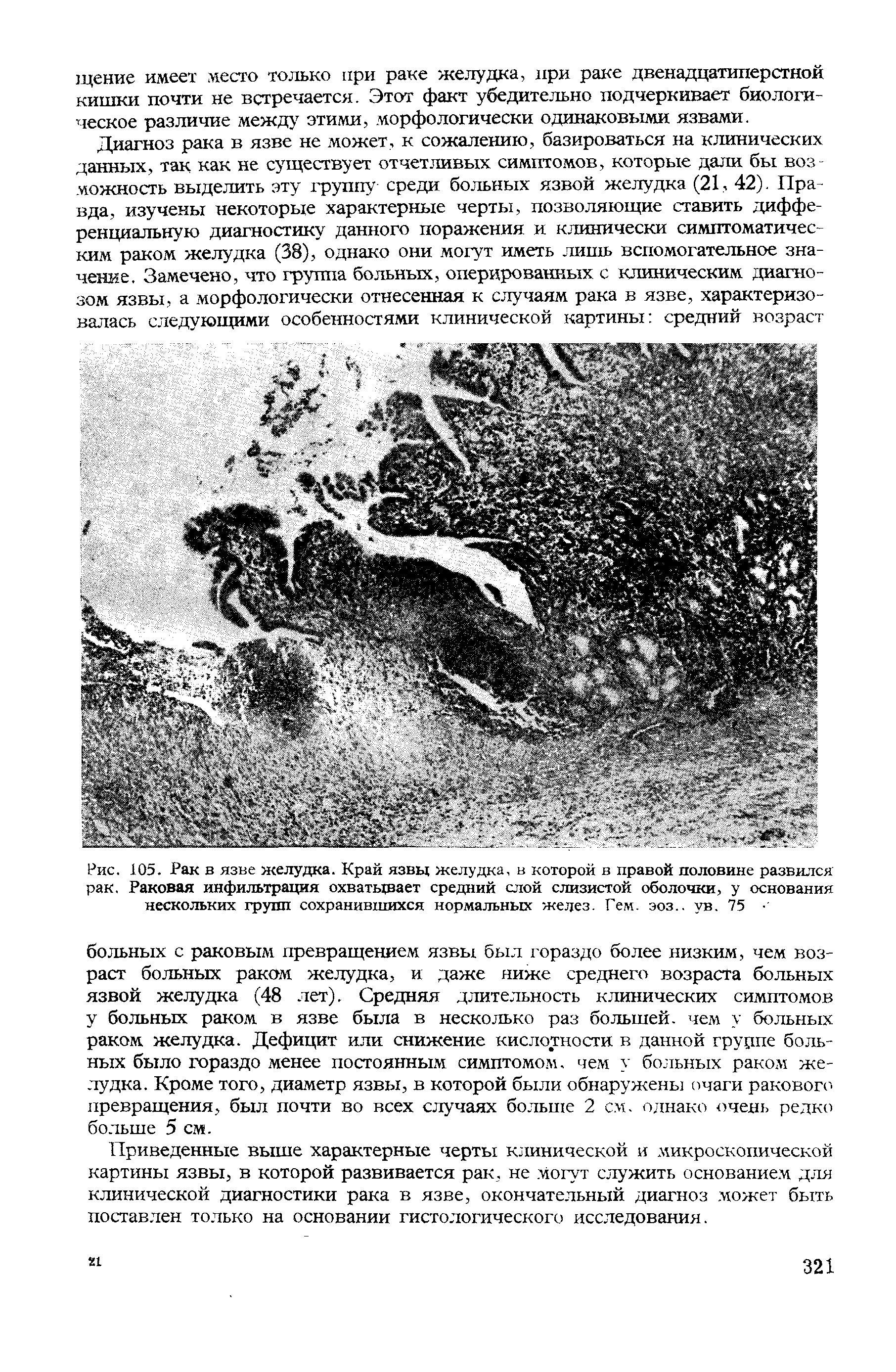 Рис. 105. Рак в язве желудка. Край язвы желудка, в которой в правой половине развился рак. Раковая инфильтрация охватывает средний слой слизистой оболочки, у основания нескольких групп сохранившихся нормальных желез. Гем. эоз.. ув. 75...