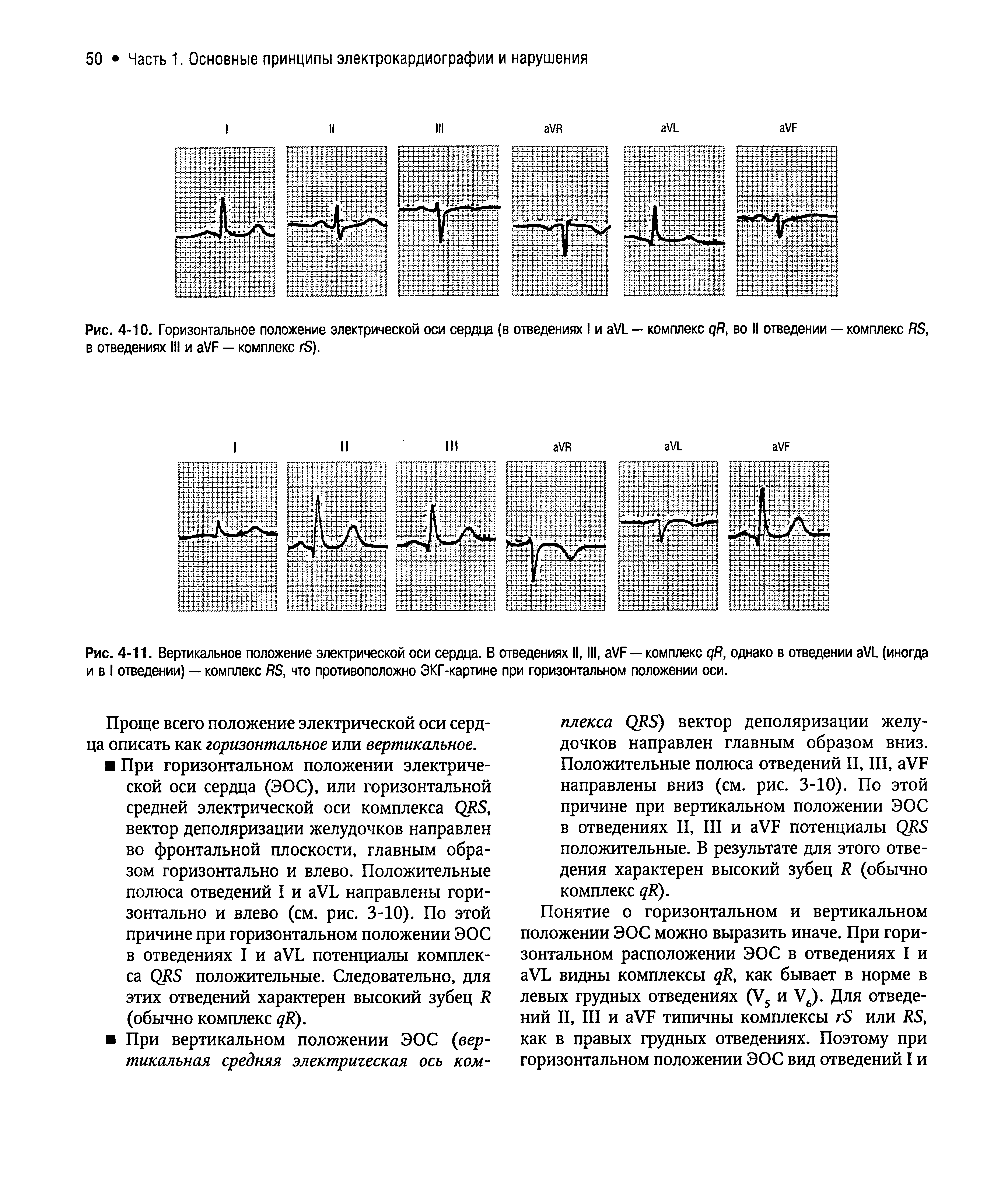 Рис. 4-11. Вертикальное положение электрической оси сердца. В отведениях II, III, VF — комплекс R, однако в отведении VL (иногда и в I отведении) — комплекс RS, что противоположно ЭКГ-картине при горизонтальном положении оси.