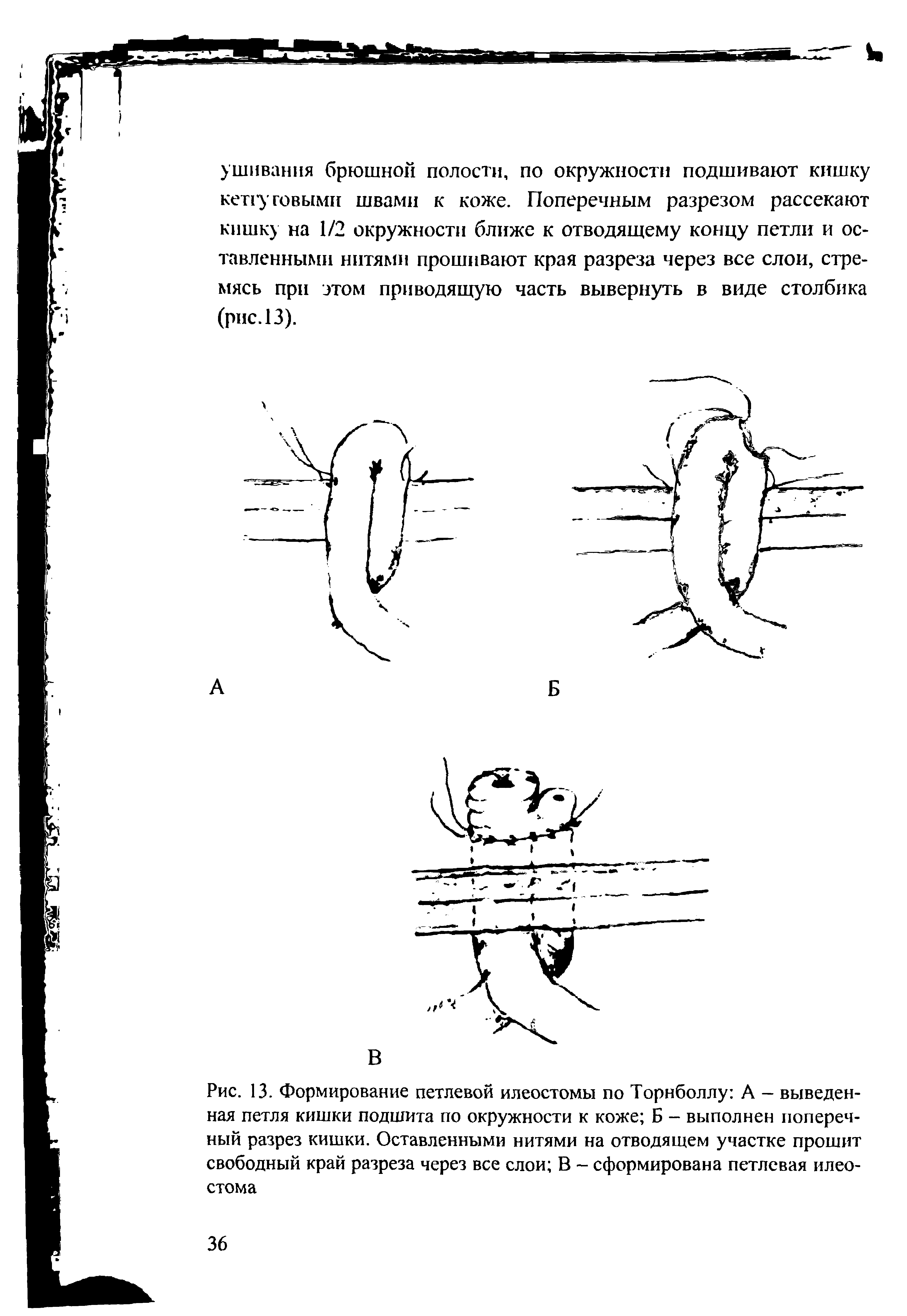 Рис. 13. Формирование петлевой илеостомы по Торнболлу А — выведенная петля кишки подшита по окружности к коже Б - выполнен поперечный разрез кишки. Оставленными нитями на отводящем участке прошит свободный край разреза через все слои В - сформирована петлевая илеостома...