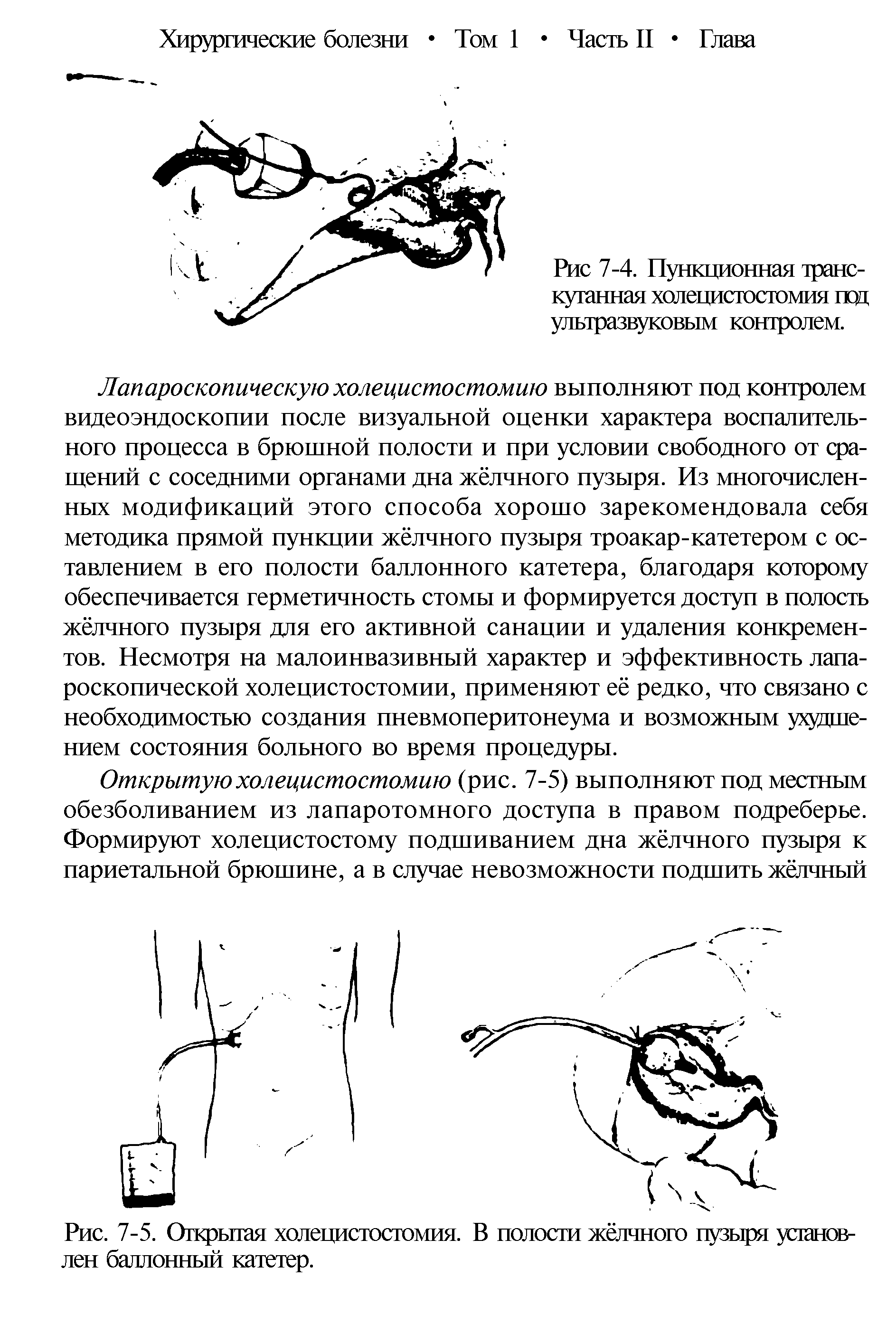 Рис. 7-5. Открытая холецистостомия. В полости жёлчного пузыря установлен баллонный катетер.