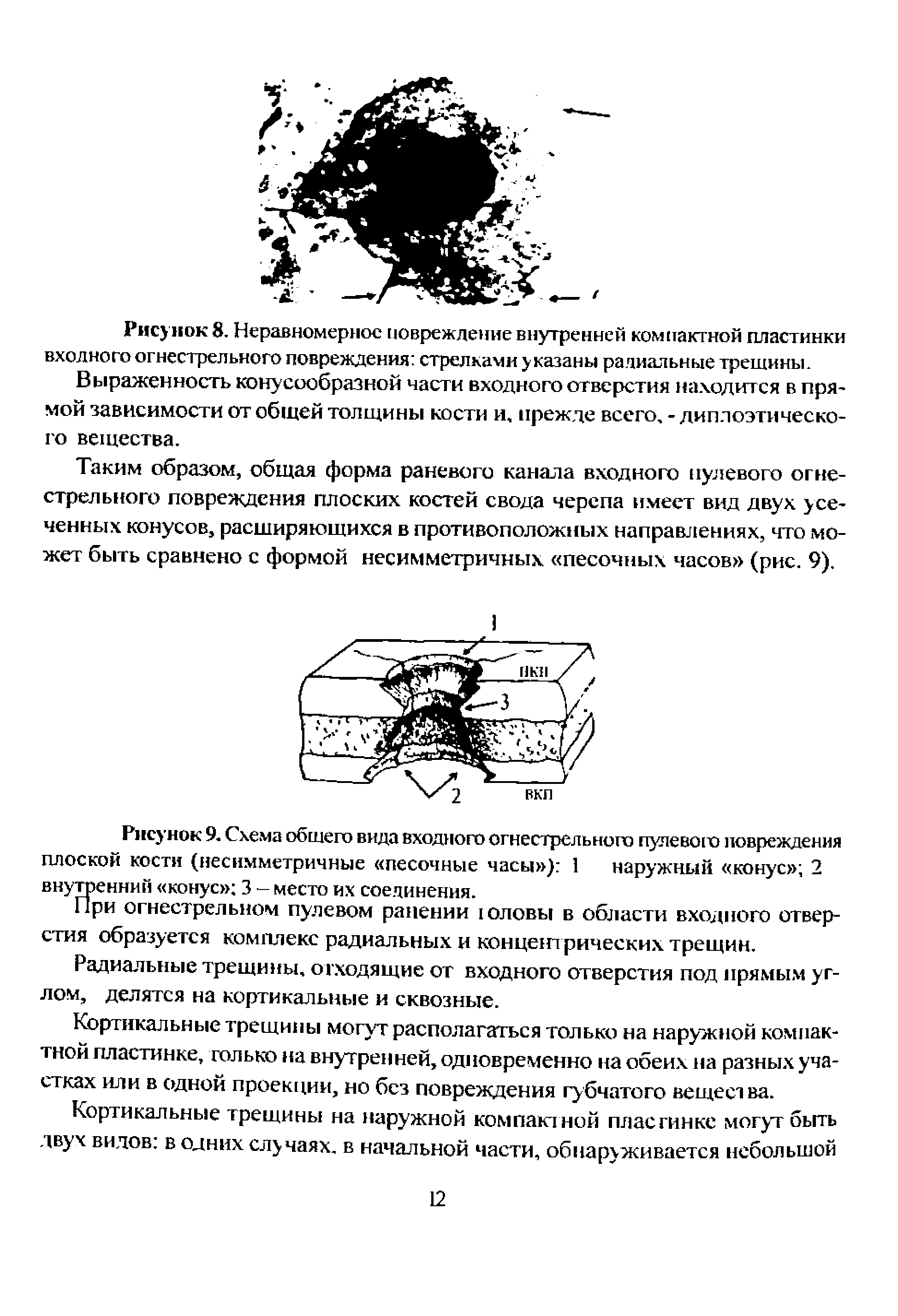 Рисунок 9. Схема общего вида входного огнестрельного пулевого повреждения плоской кости (несимметричные песочные часы ) 1 наружный конус 2 внутоенний конус 3 - место их соединения.