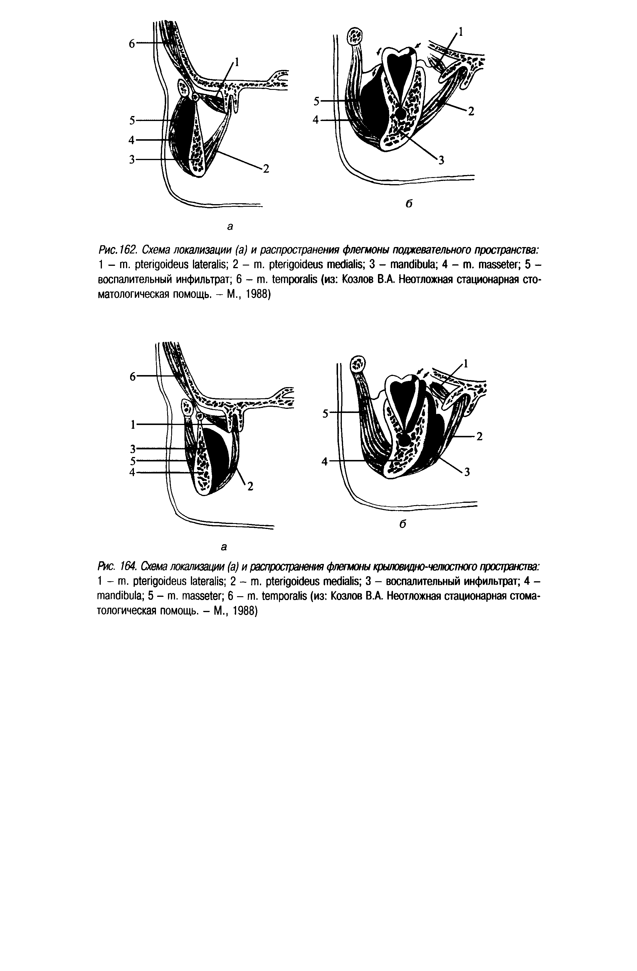 Рис. 164. Схема локализации (а) и распространения флегмоны крыловидно-челюстного пространства 1 - . 2 - т. 3 - воспалительный инфильтрат 4 - 5 - . 6 - . (из Козлов B.A. Неотложная стационарная стоматологическая помощь. - М., 1988)...