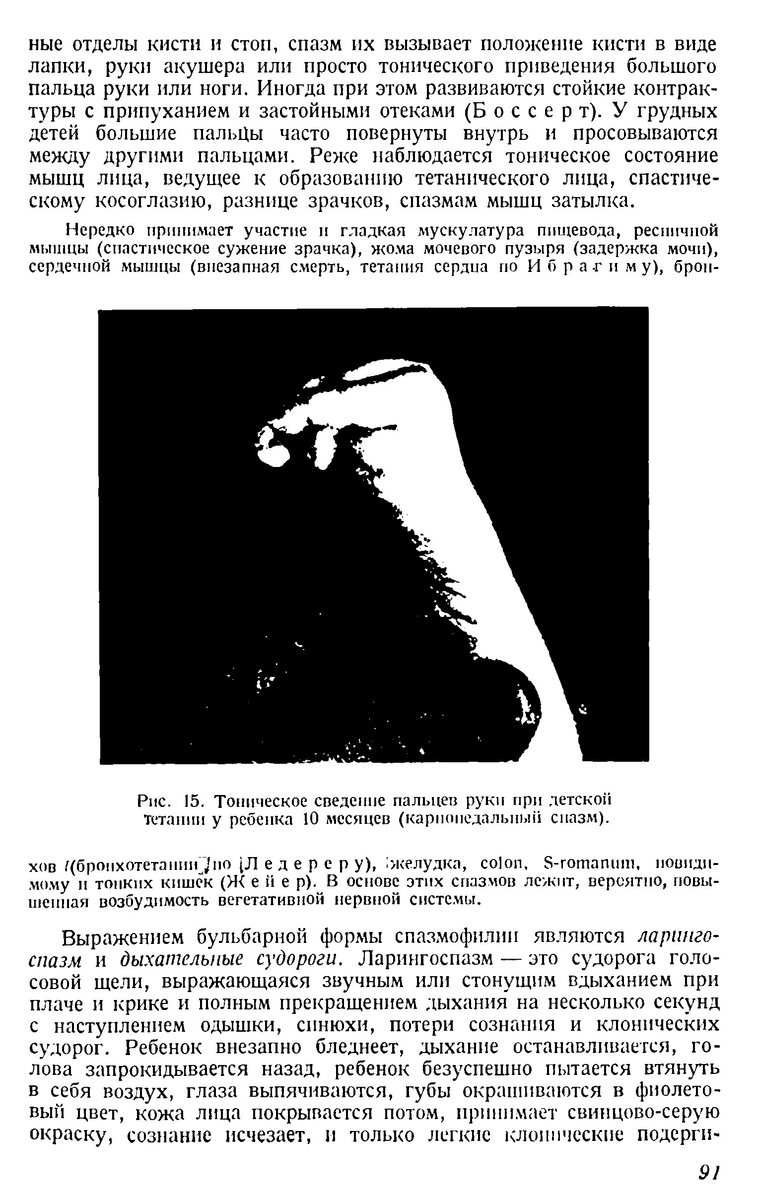 Рис. 15. Тоническое сведение пальцев руки при детской Тетании у ребенка 10 месяцев (карпопедальный спазм).