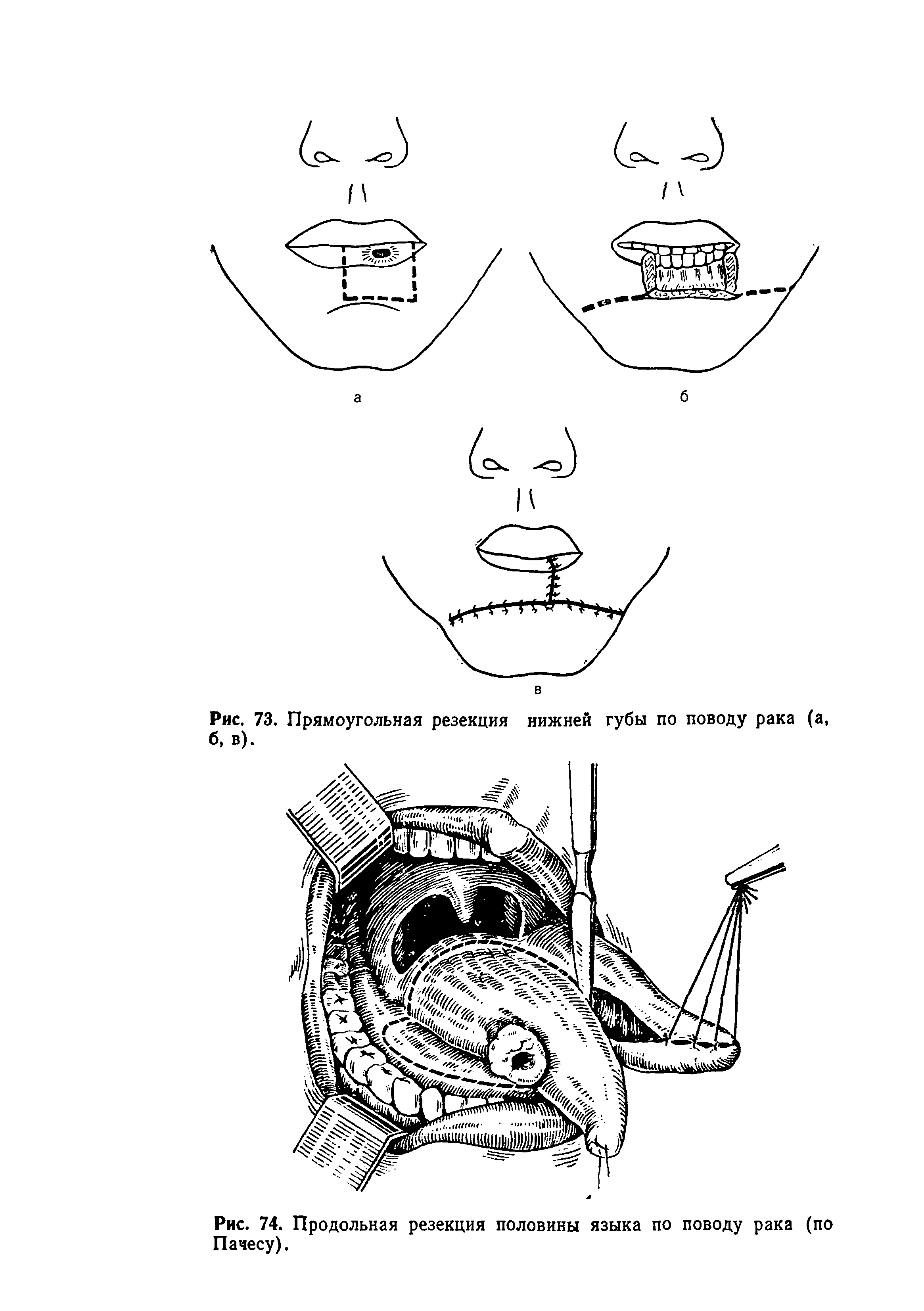 Рис. 74. Продольная резекция половины языка по поводу рака (по Пачесу).