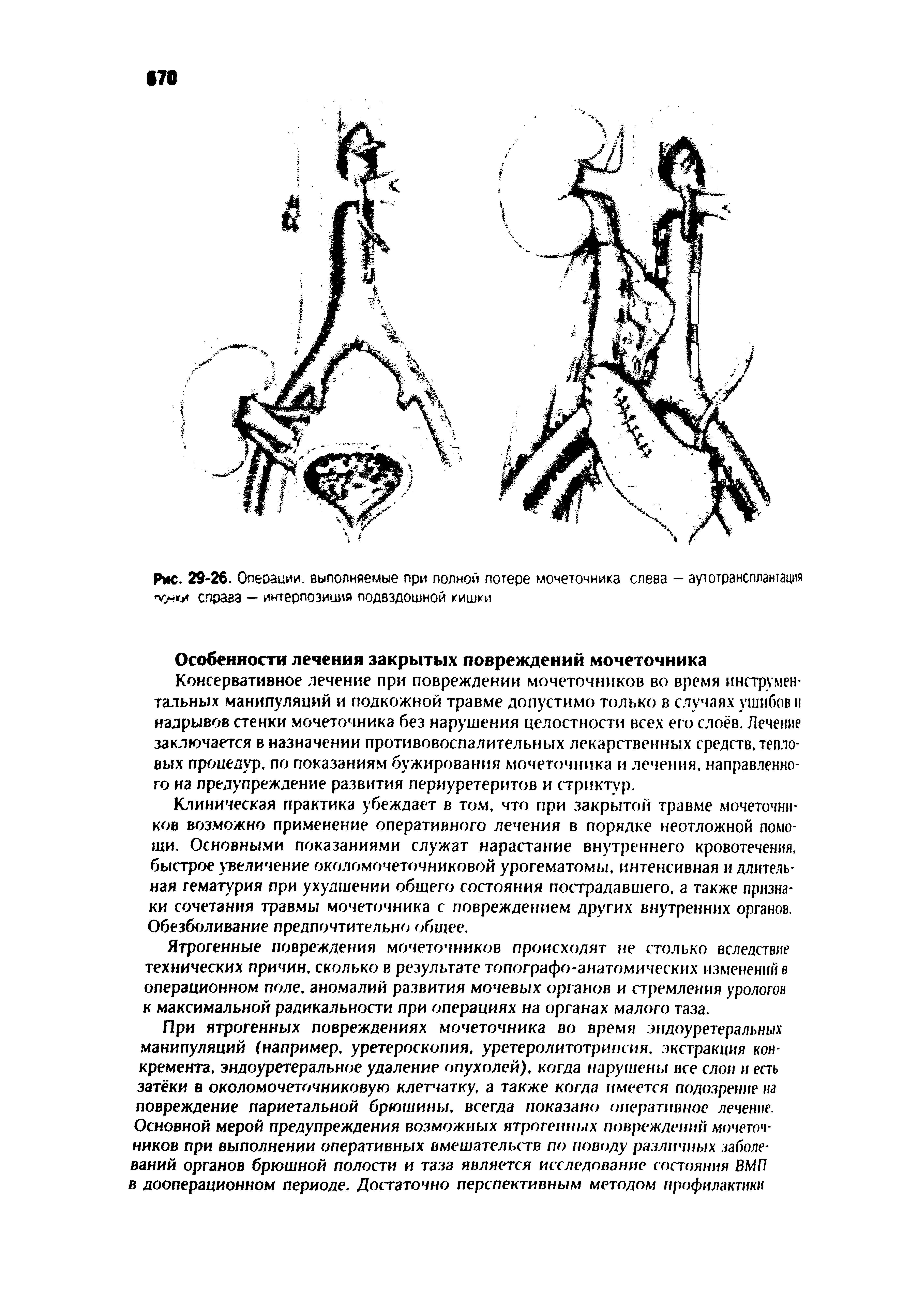 Рис. 29-26. Опеоации. выполняемые при полной потере мочеточника слева - аутотрансплантация справа — интерпозиция подвздошной кишки...