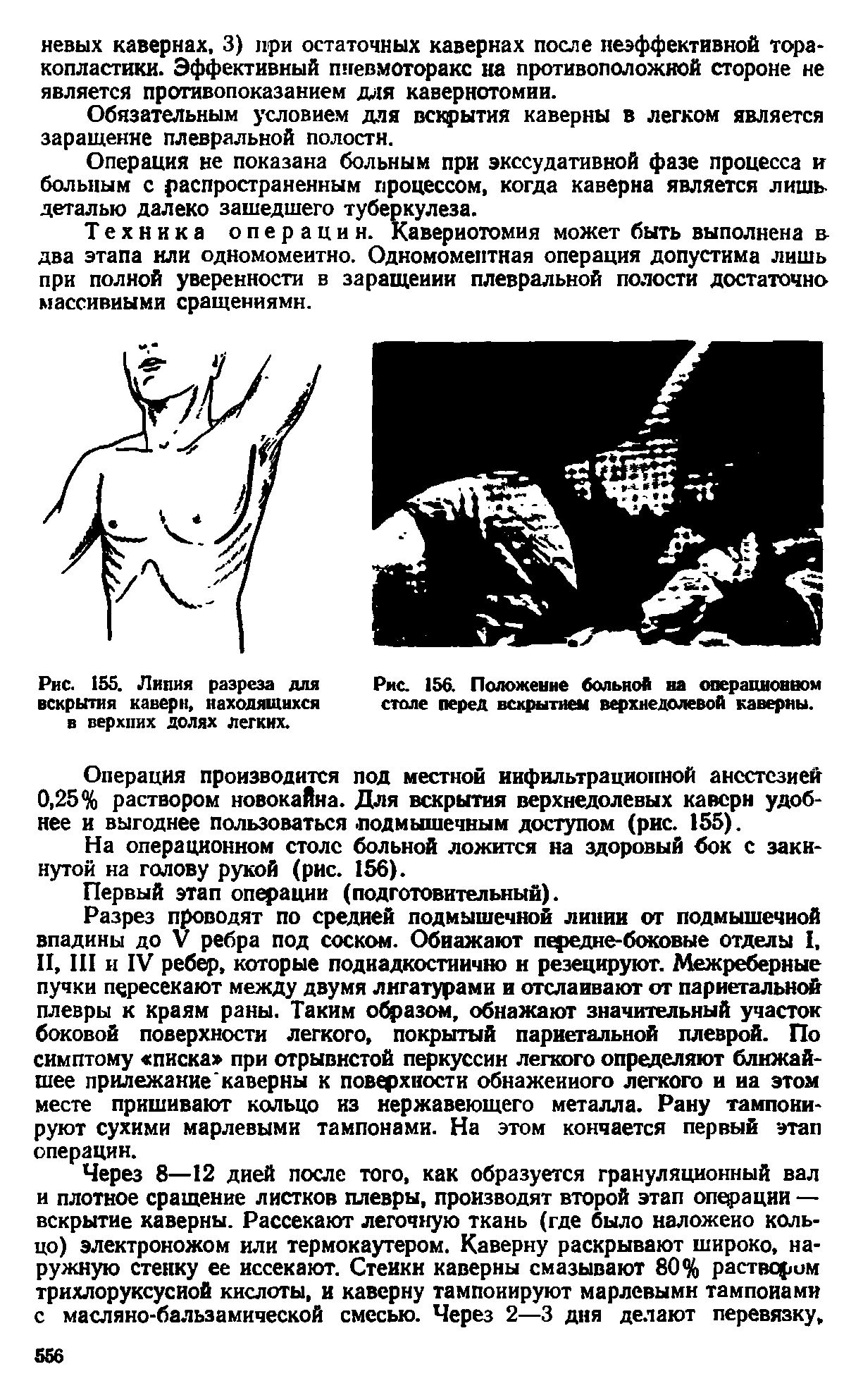 Рис. 156. Положение больной на операционном столе перед вскрытием верхнедолевой каверны.