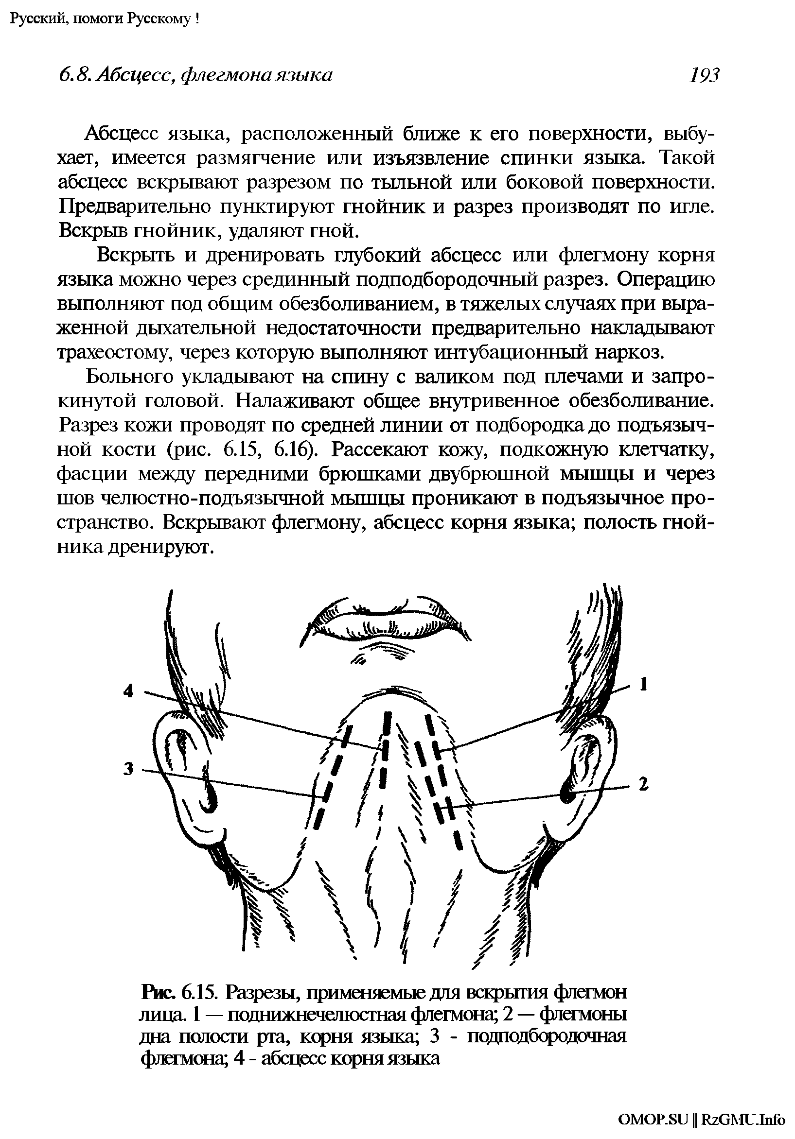 Рис. 6.15. Разрезы, применяемые для вскрытия флегмон лица. 1 — поднижнечелюстная флегмона 2 — флегмоны дна полости рта, корня языка 3 - подподбородочная флегмона 4 - абсцесс корня языка...