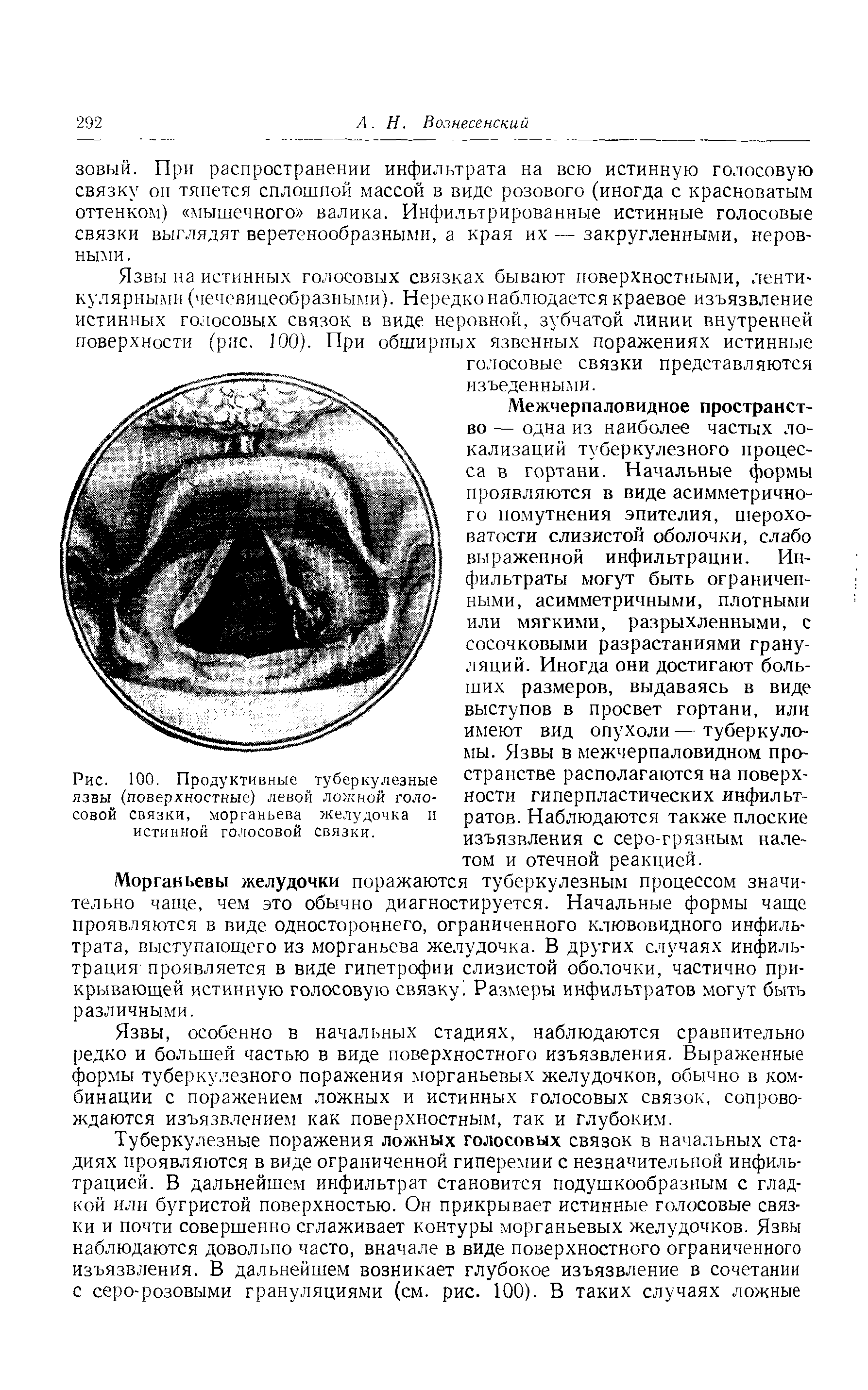 Рис. 100. Продуктивные туберкулезные язвы (поверхностные) левой ложной голосовой связки, морганьева желудочка и истинной голосовой связки.