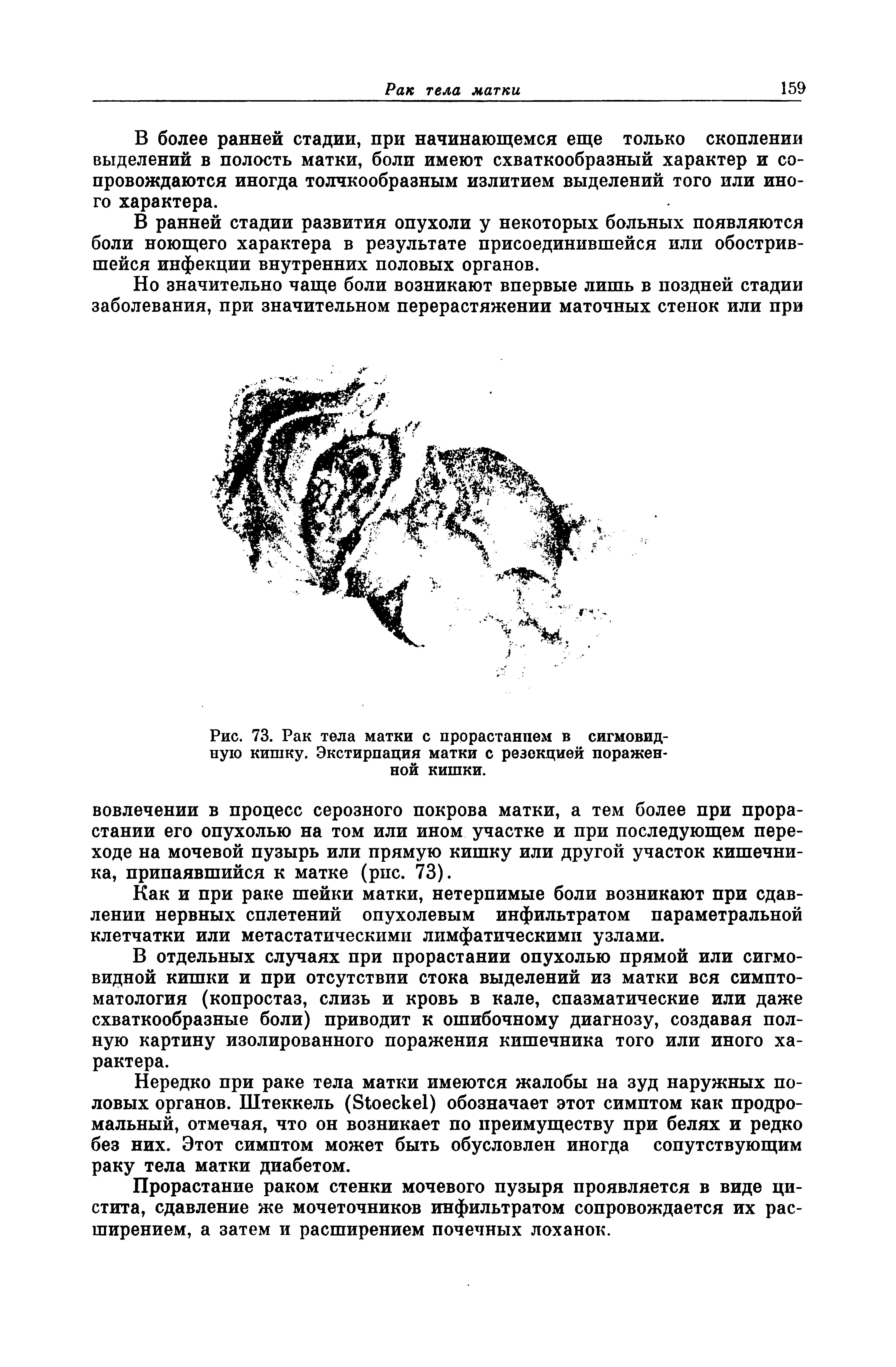 Рис. 73. Рак тела матки с прорастанием в сигмовидную кишку. Экстирпация матки с резекцией пораженной кишки.