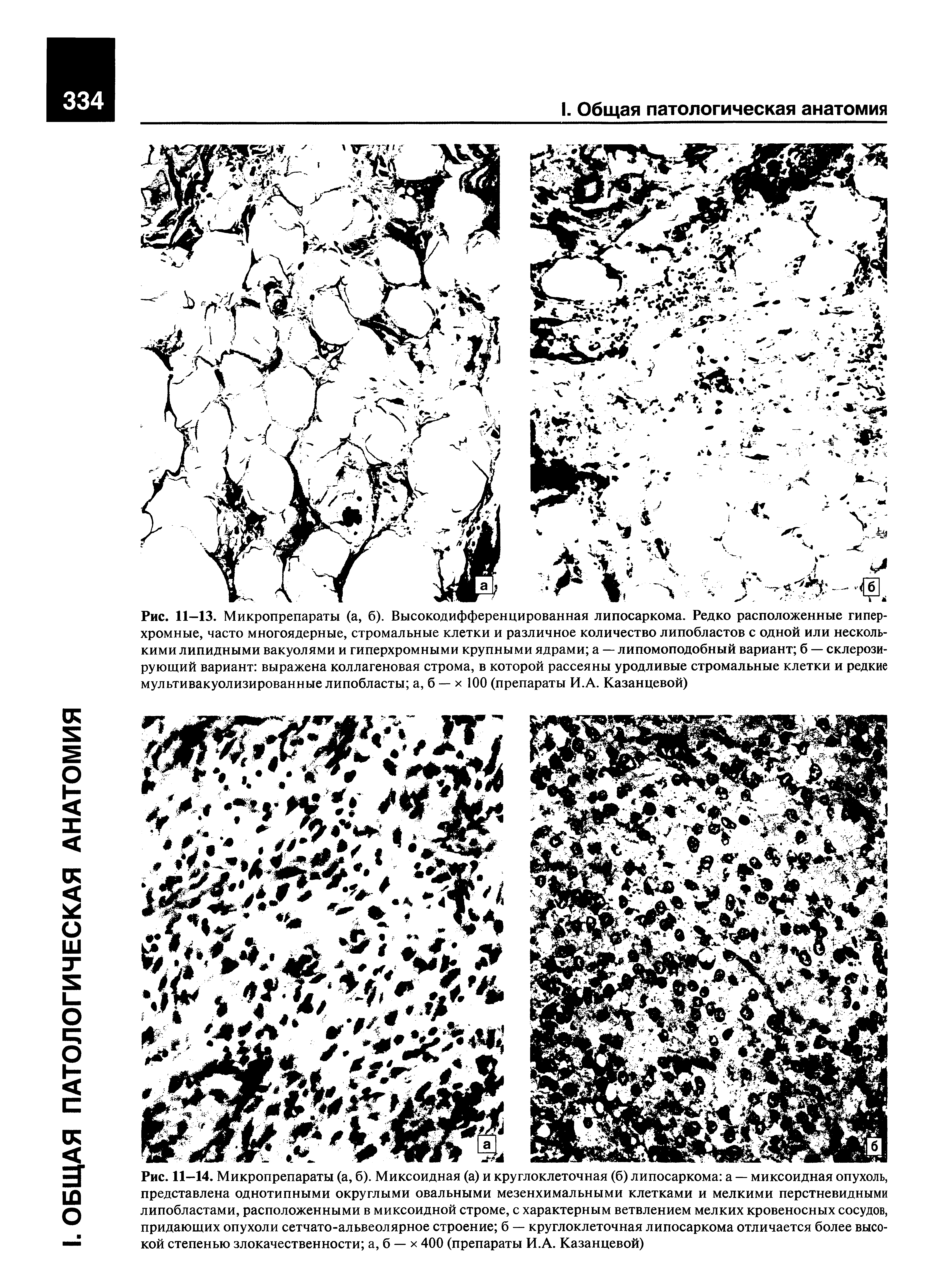 Рис. 11—14. Микропрепараты (а, б). Миксоидная (а) и круглоклеточная (б) липосаркома а — миксоидная опухоль,...