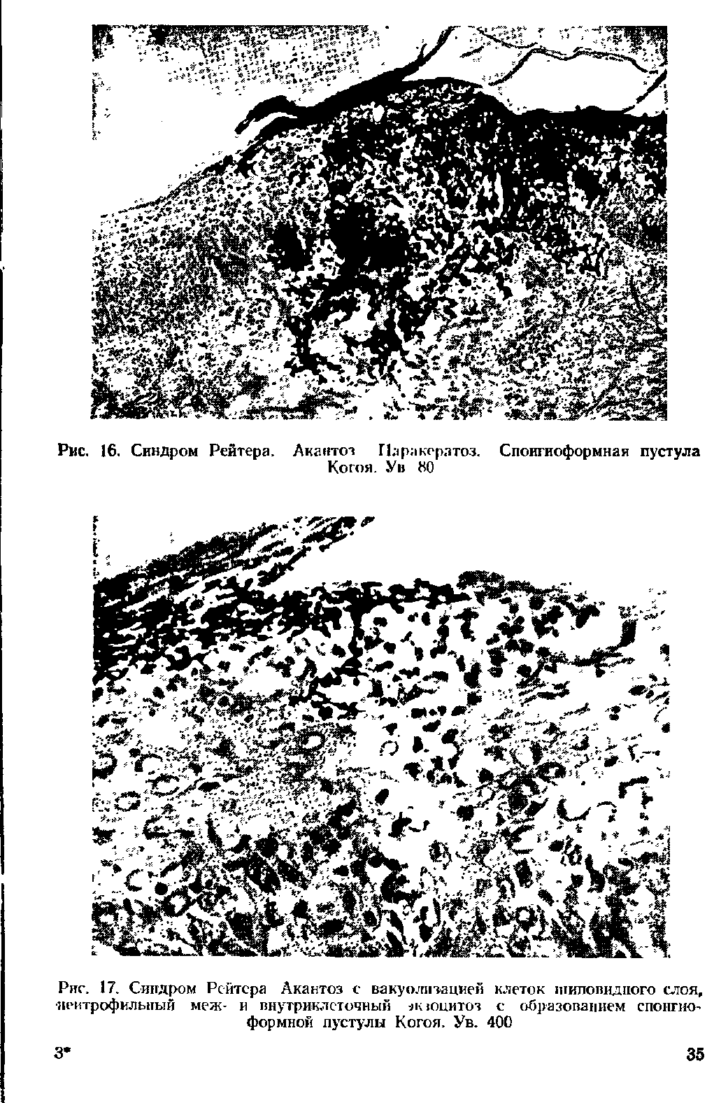 Рис. 17. Синдром Рейтера Акантоз с вакуолизацией клеток шиловидного слоя, нейтрофильный меж- и внутриклеточный оцитоз с образованием спонгио формной пустулы Когоя. Ув. 400...